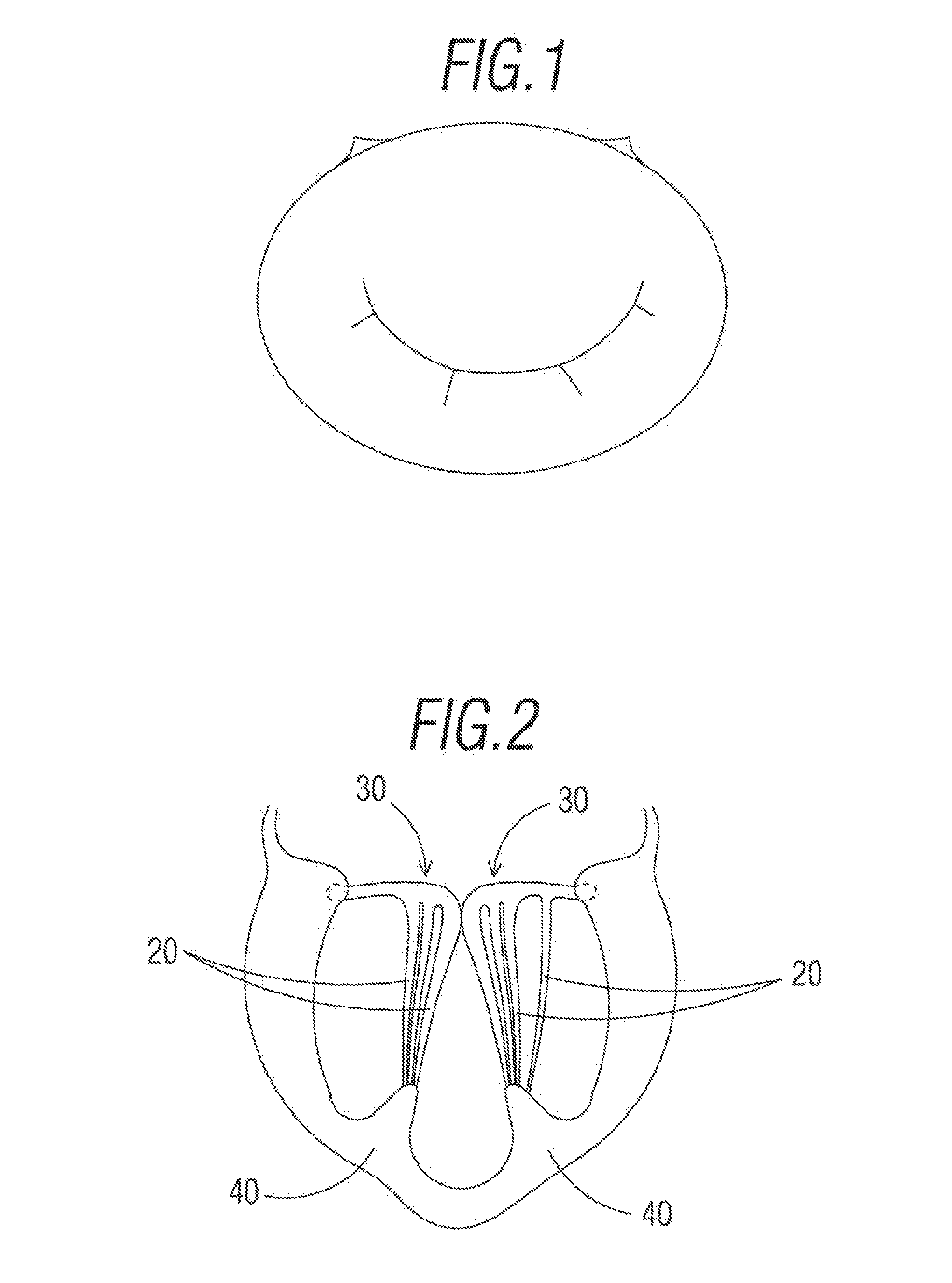 Prosthetic band, in particular for repairing a mitral valve