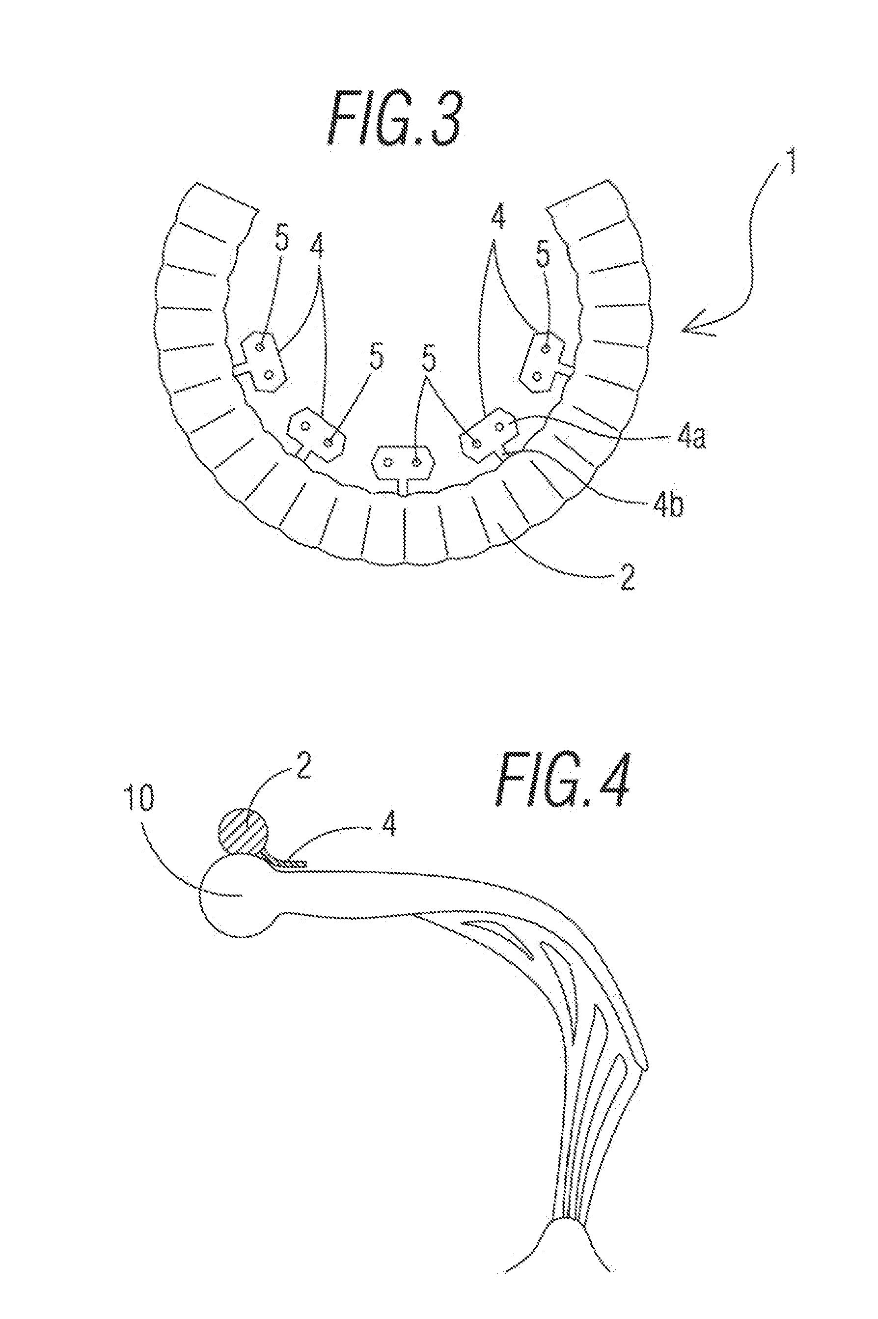 Prosthetic band, in particular for repairing a mitral valve