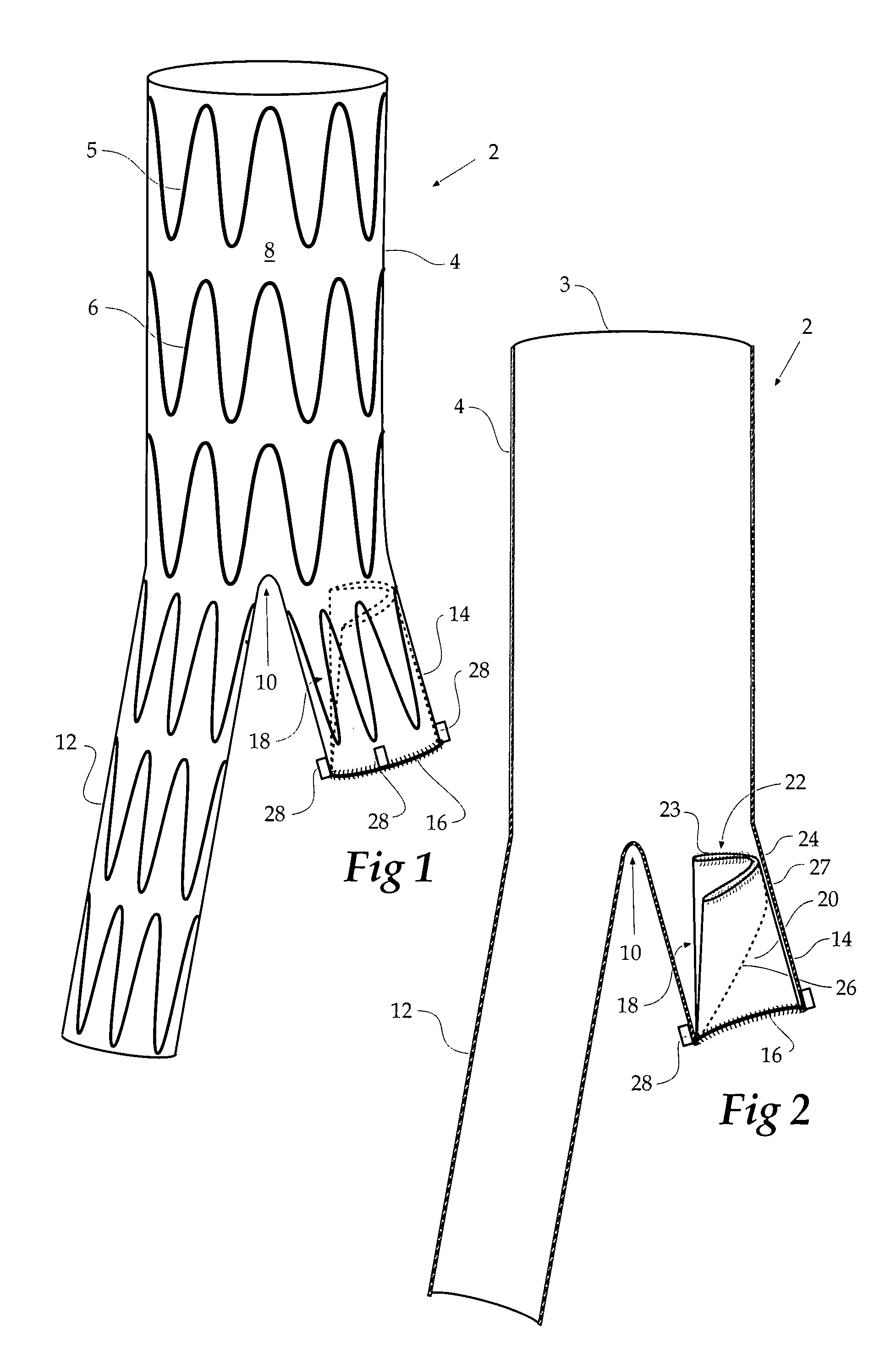 Stent graft for treatment of emergency rupture of a vessel