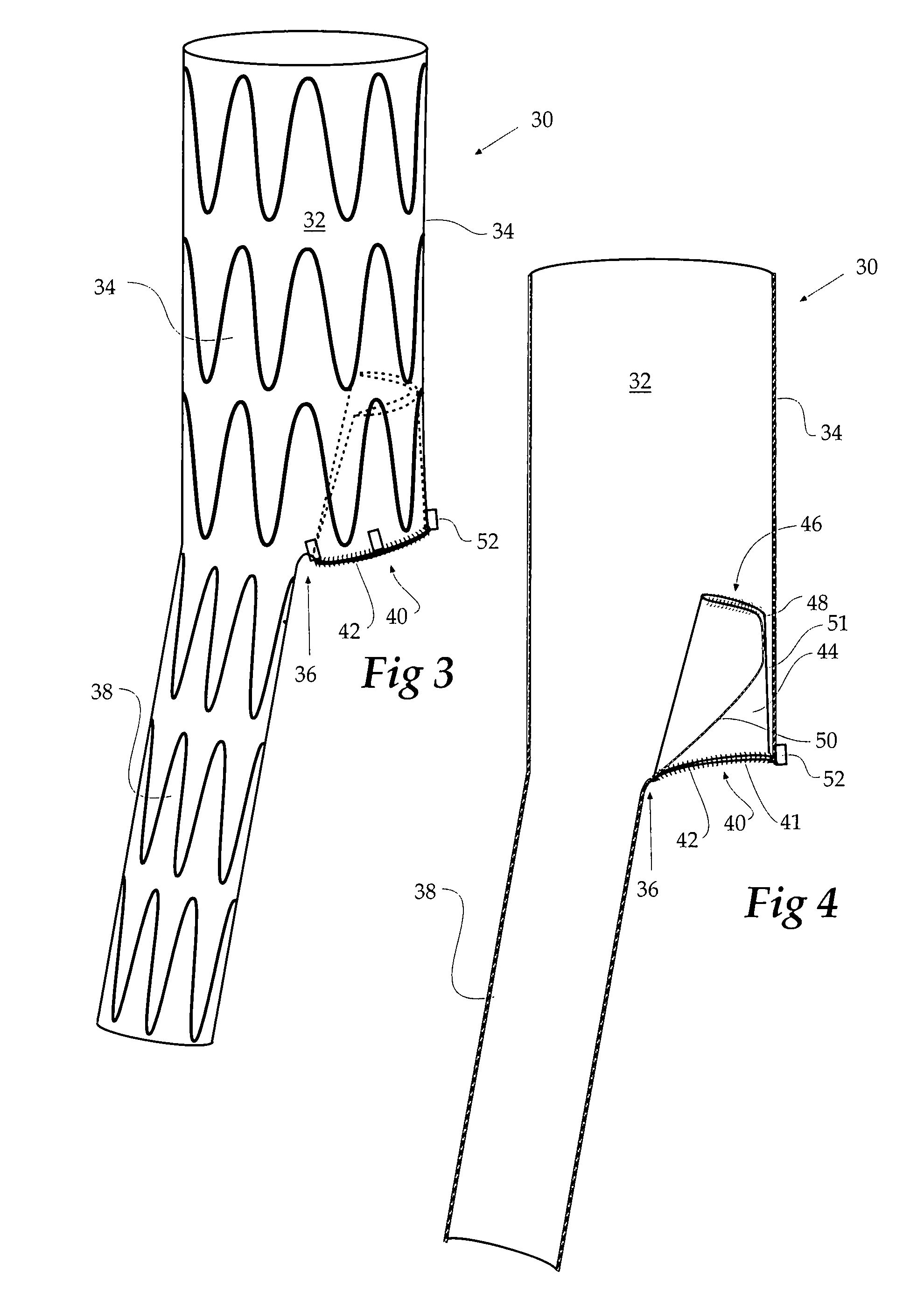 Stent graft for treatment of emergency rupture of a vessel