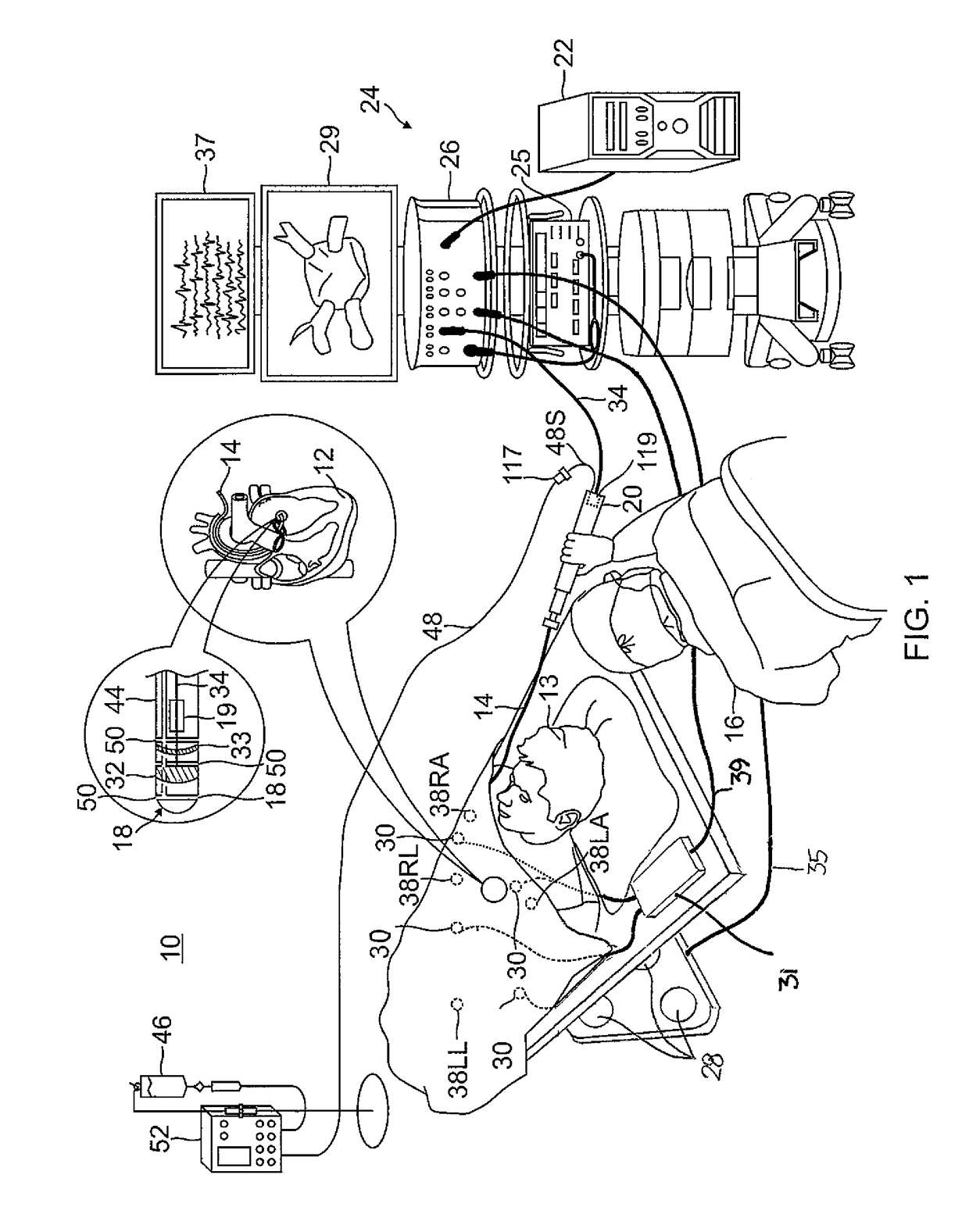 Electrocardiogram noise reduction