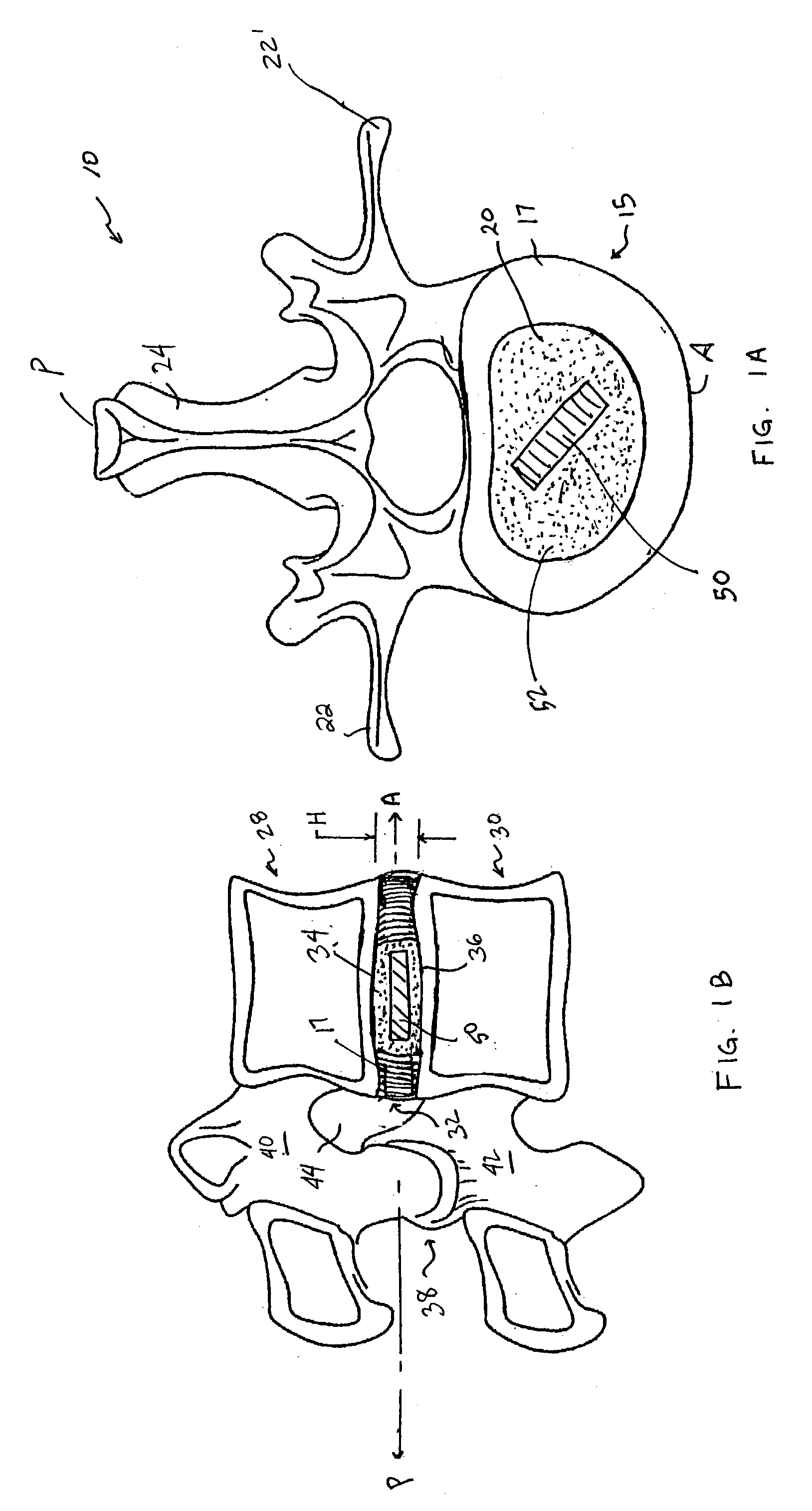 Devices and method for augmenting a vertebral disc