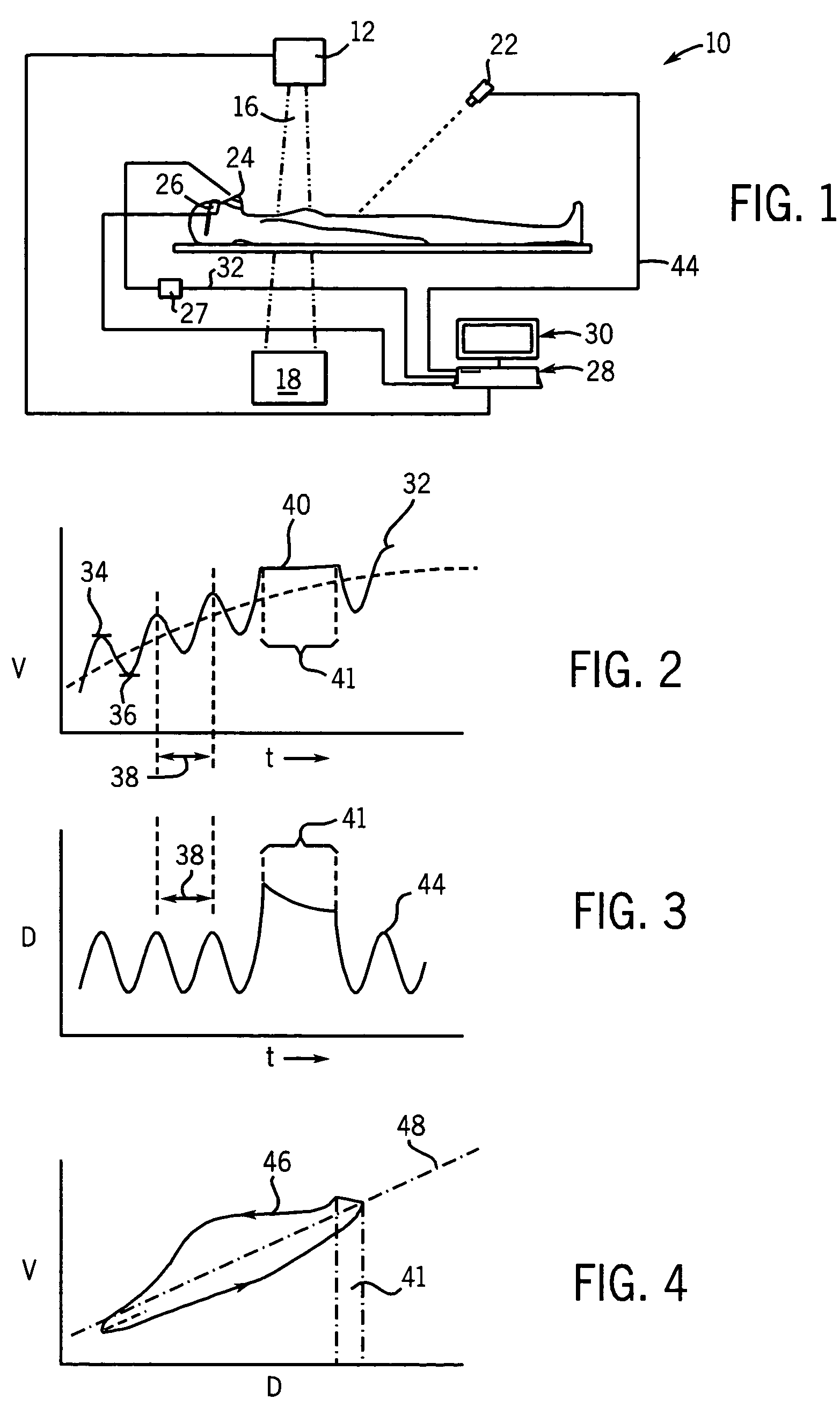 Combined laser spirometer motion tracking system for radiotherapy