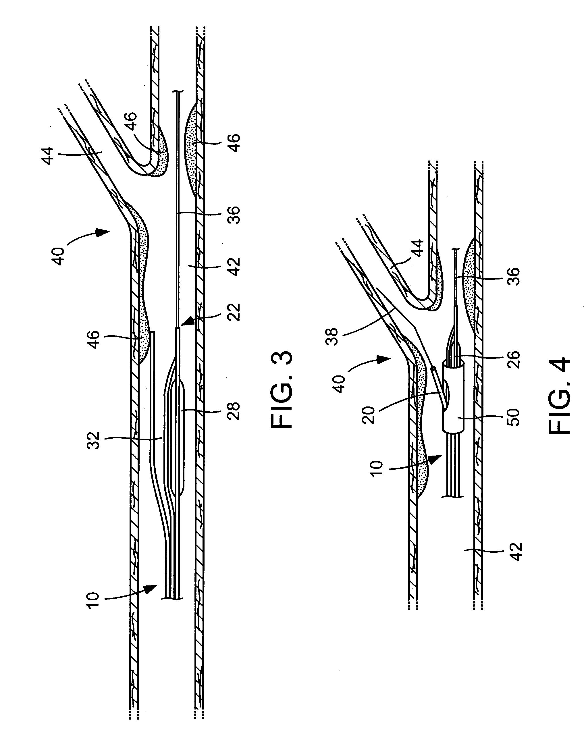 Catheter balloon systems and methods