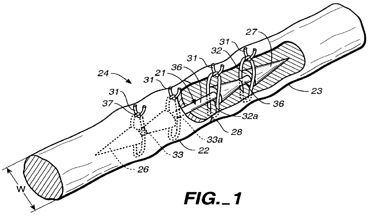 Splint with flexible body for repair of tendons or ligaments and method