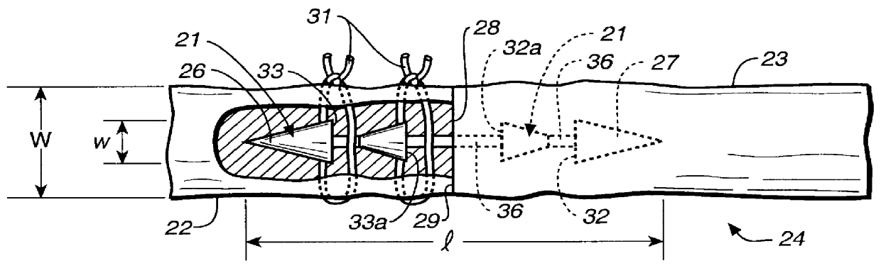 Splint with flexible body for repair of tendons or ligaments and method