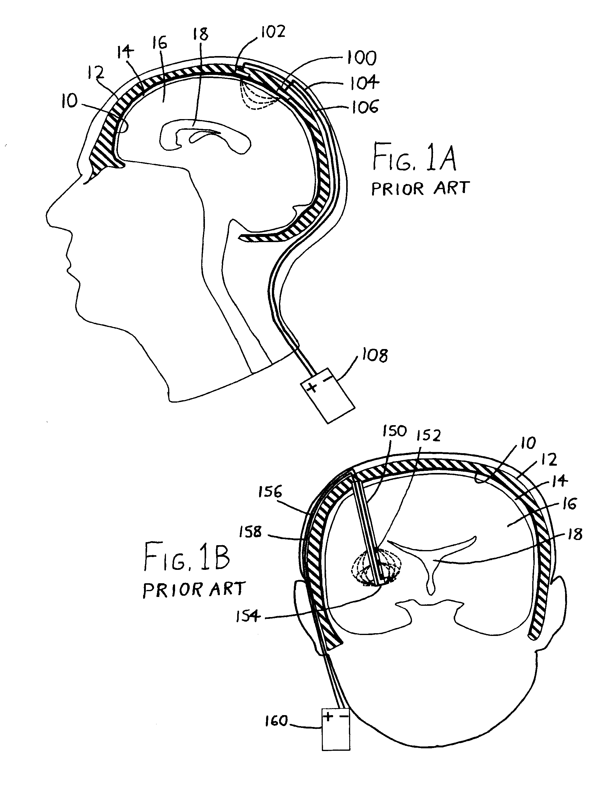 Intraventricular electrodes for electrical stimulation of the brain