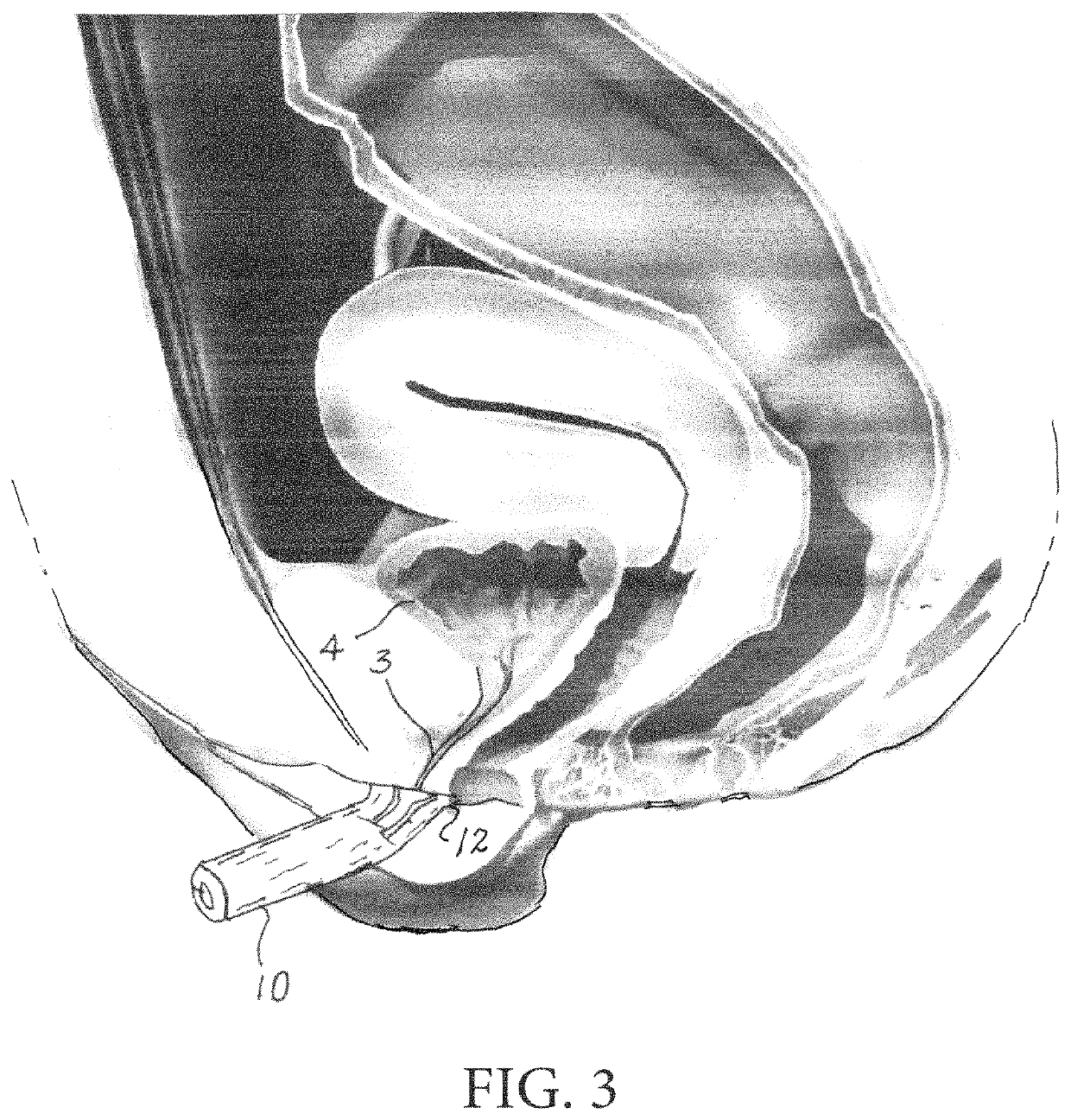 Automated collection and analysis of body fluids