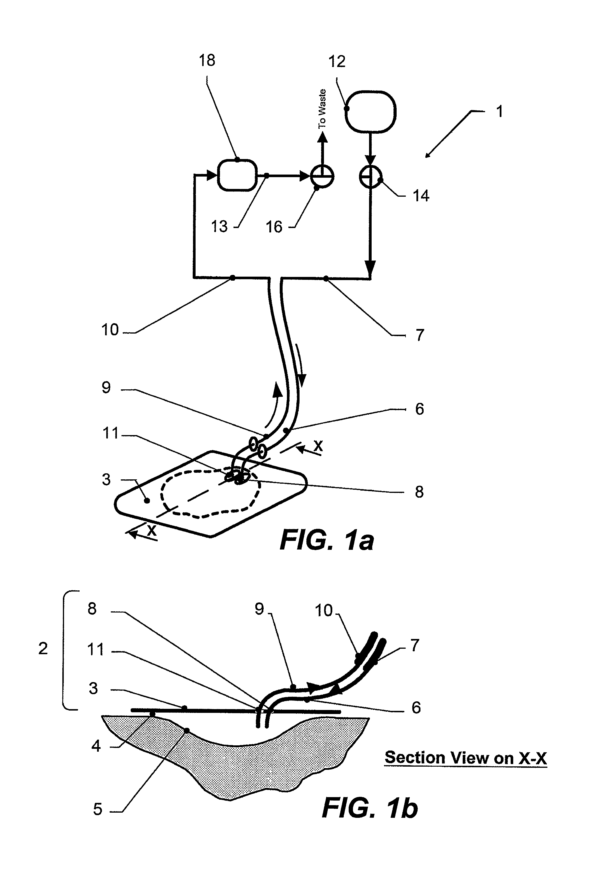 Wound treatment apparatus and method