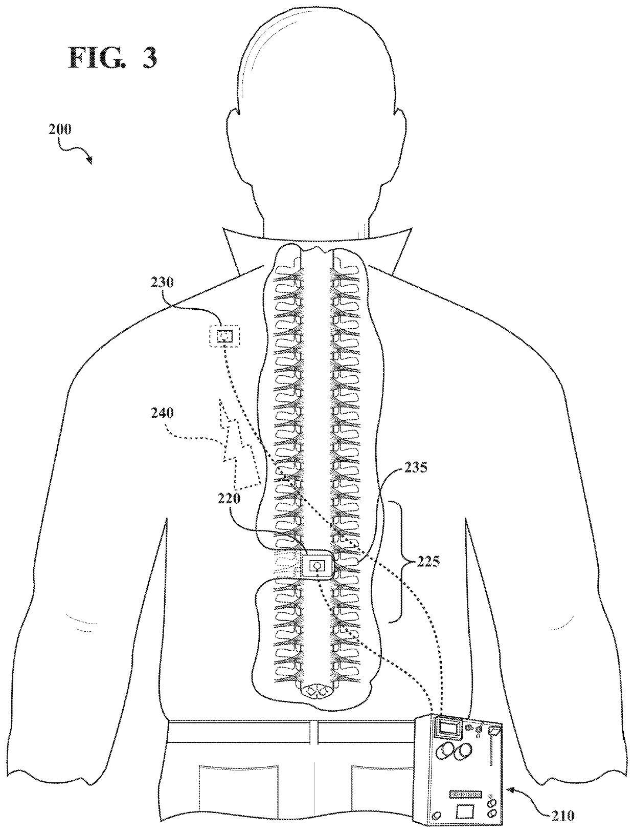 Transcutaneous spinal cord stimulation for treatment of psychiatric disorders