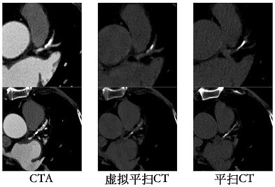 Calcification score calculation method and device based on energy spectrum CT