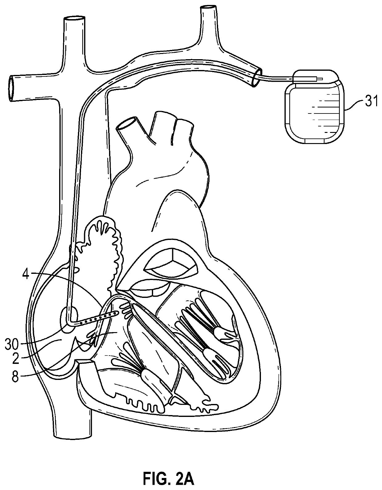 Systems, devices, and methods for his bundle cardiac pacing