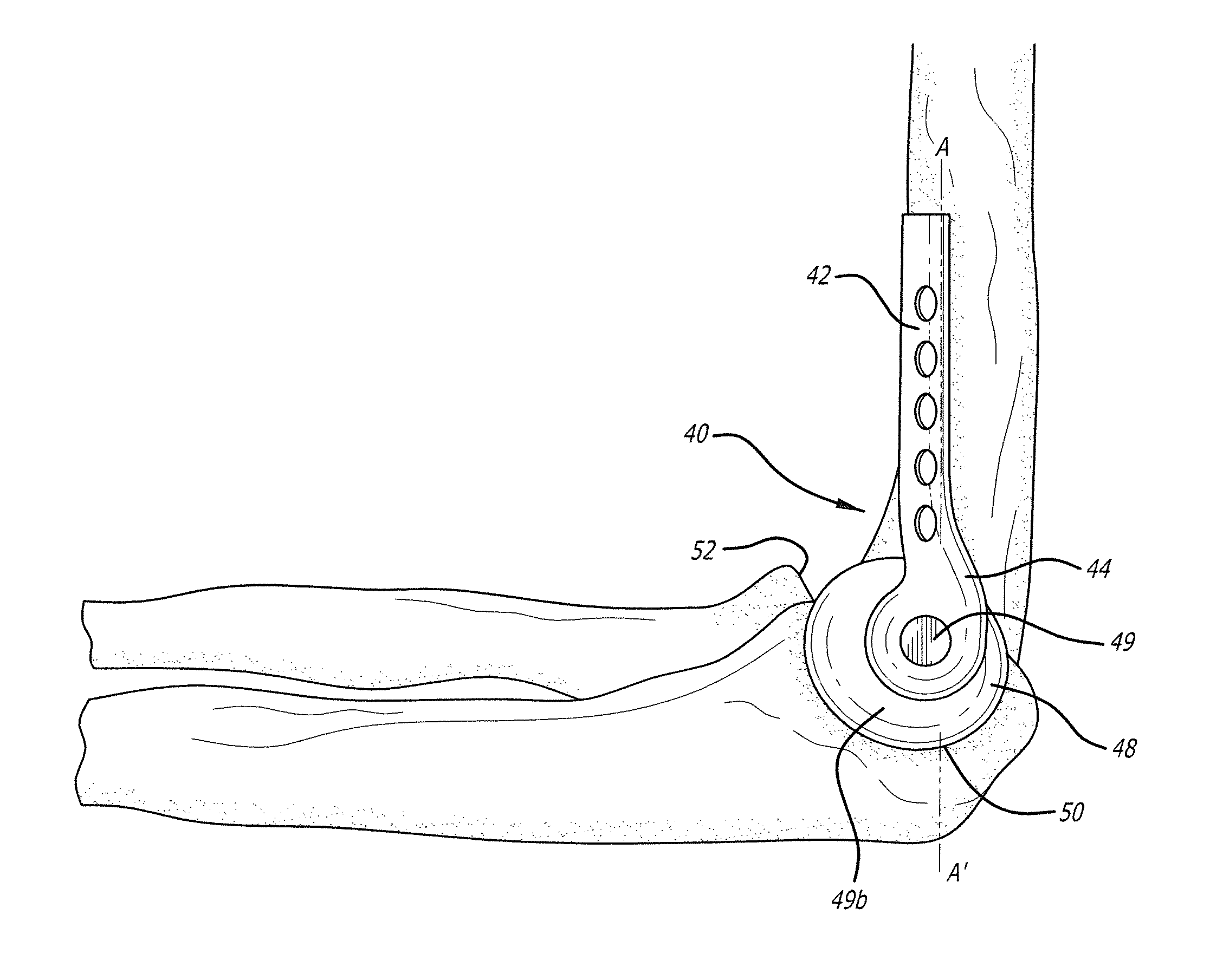 Bone joint replacement and repair assembly and method of repairing and replacing a bone joint