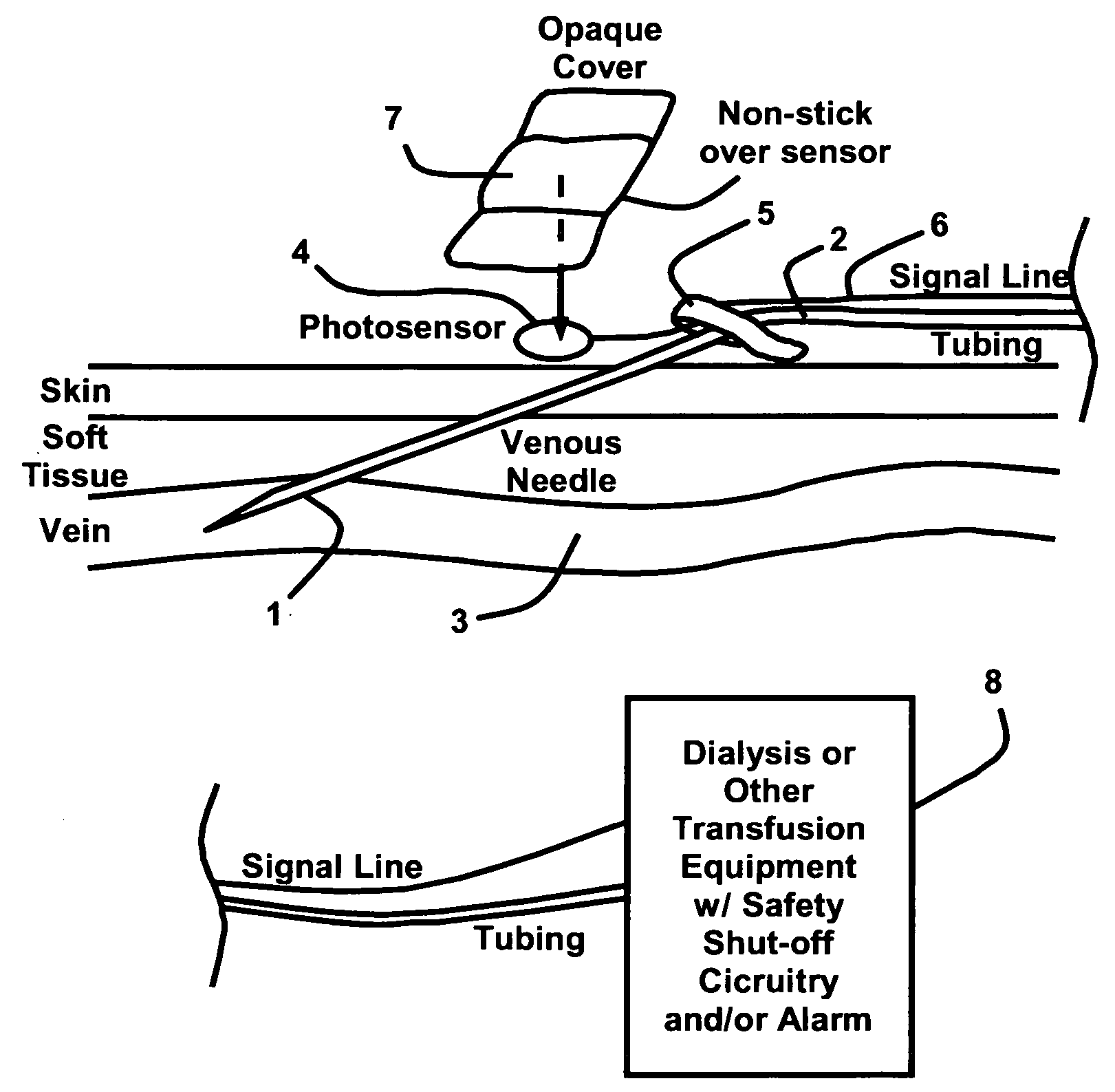 Venous needle dislodgement sensor