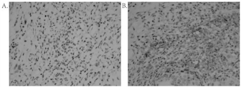 Method for predicting PD-L1 level in breast cancer tumor tissue by using peripheral blood PD-1/PD-L1