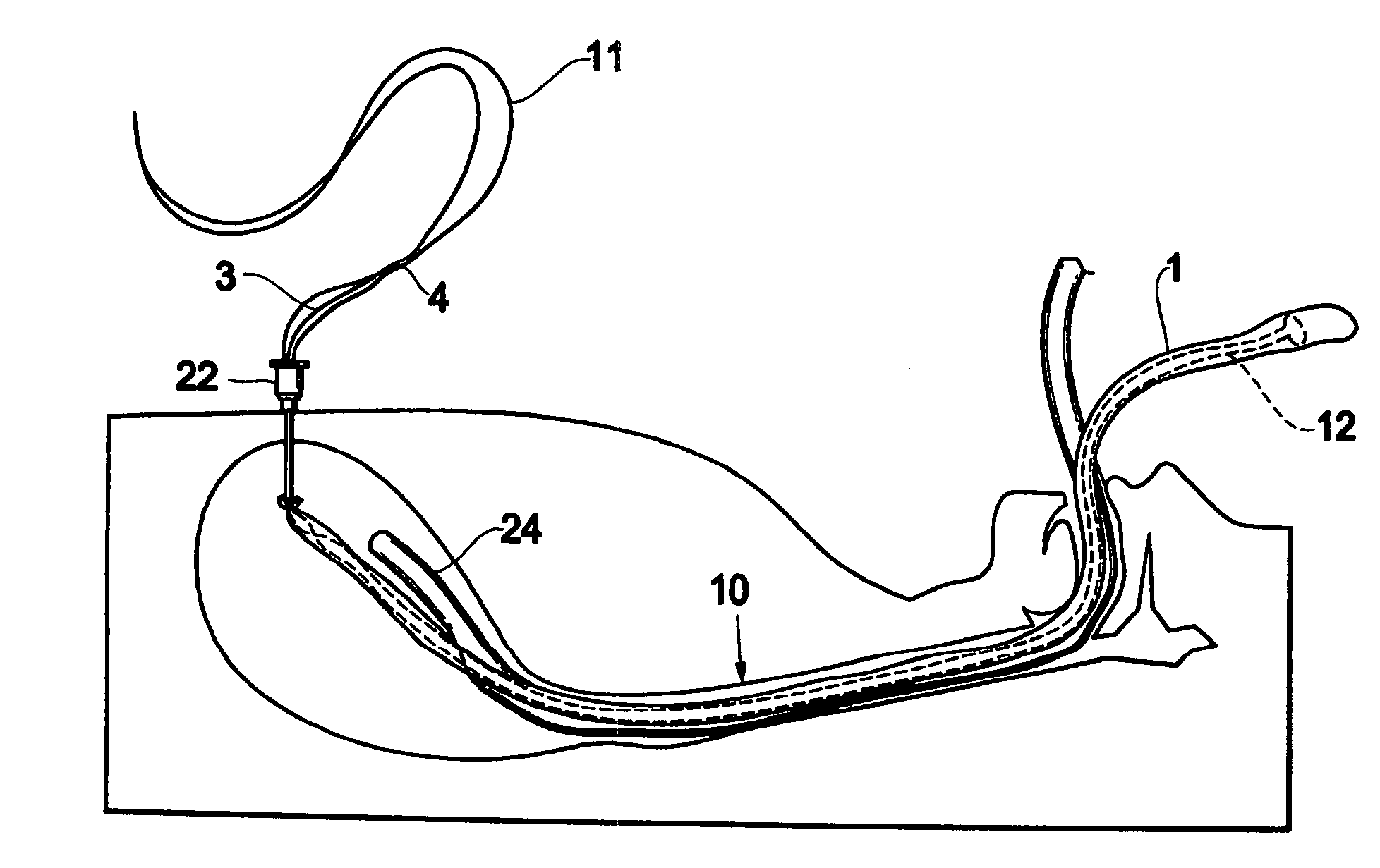 Method of gastrostomy, and an infection preventive cover, kit or catheter kit, and a gastrostomy catheter kit