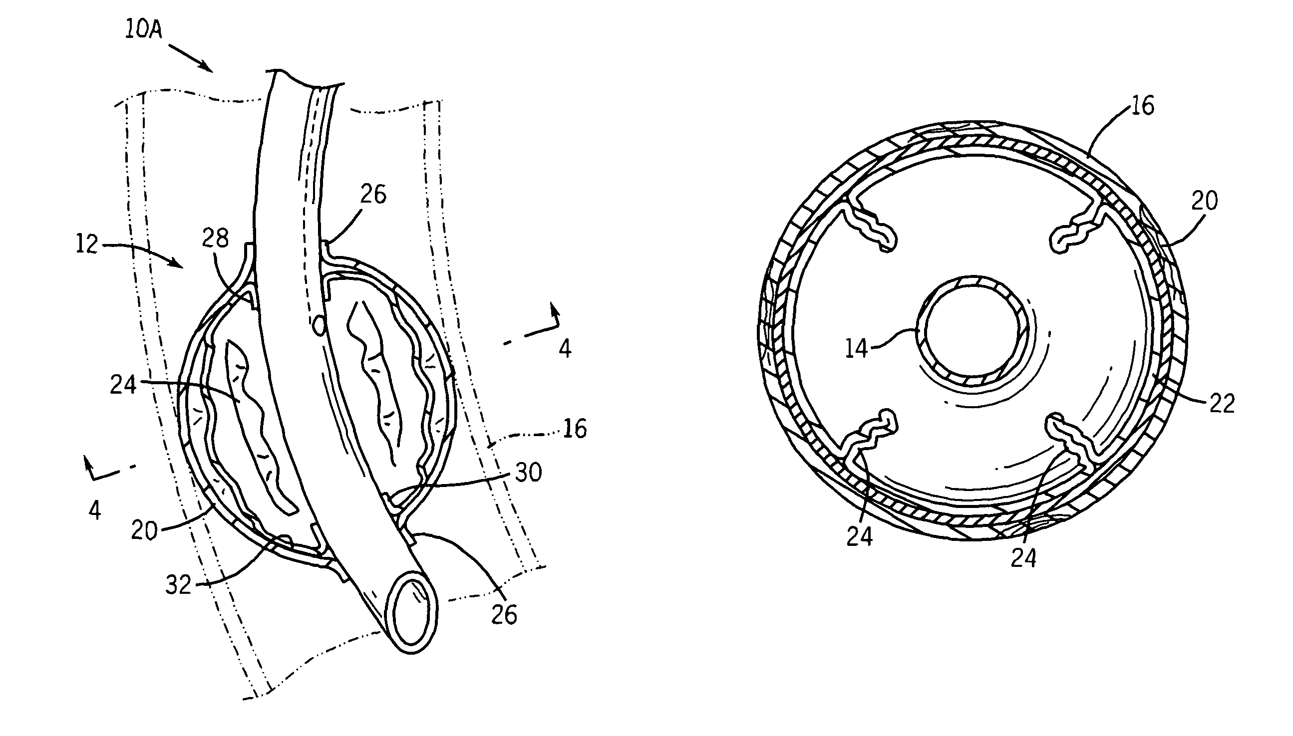 Endotracheal cuff and technique for using the same