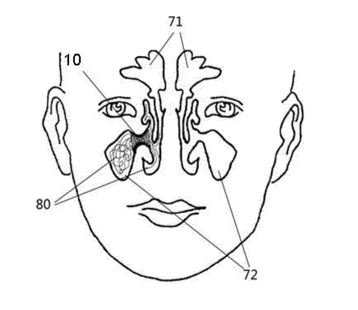 Implanted system for treating sinusitis or allergic rhinitis