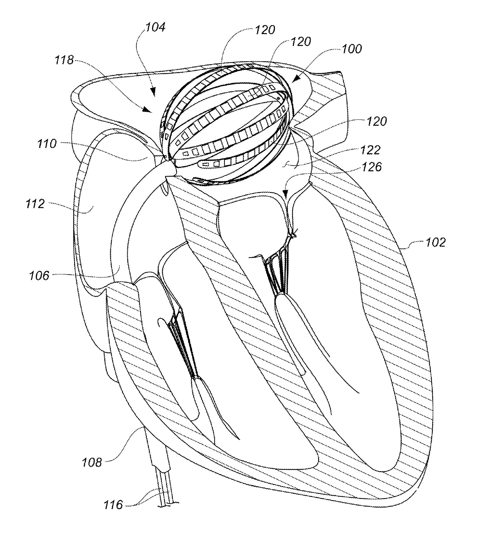 Enhanced medical device for use in bodily cavities, for example an atrium