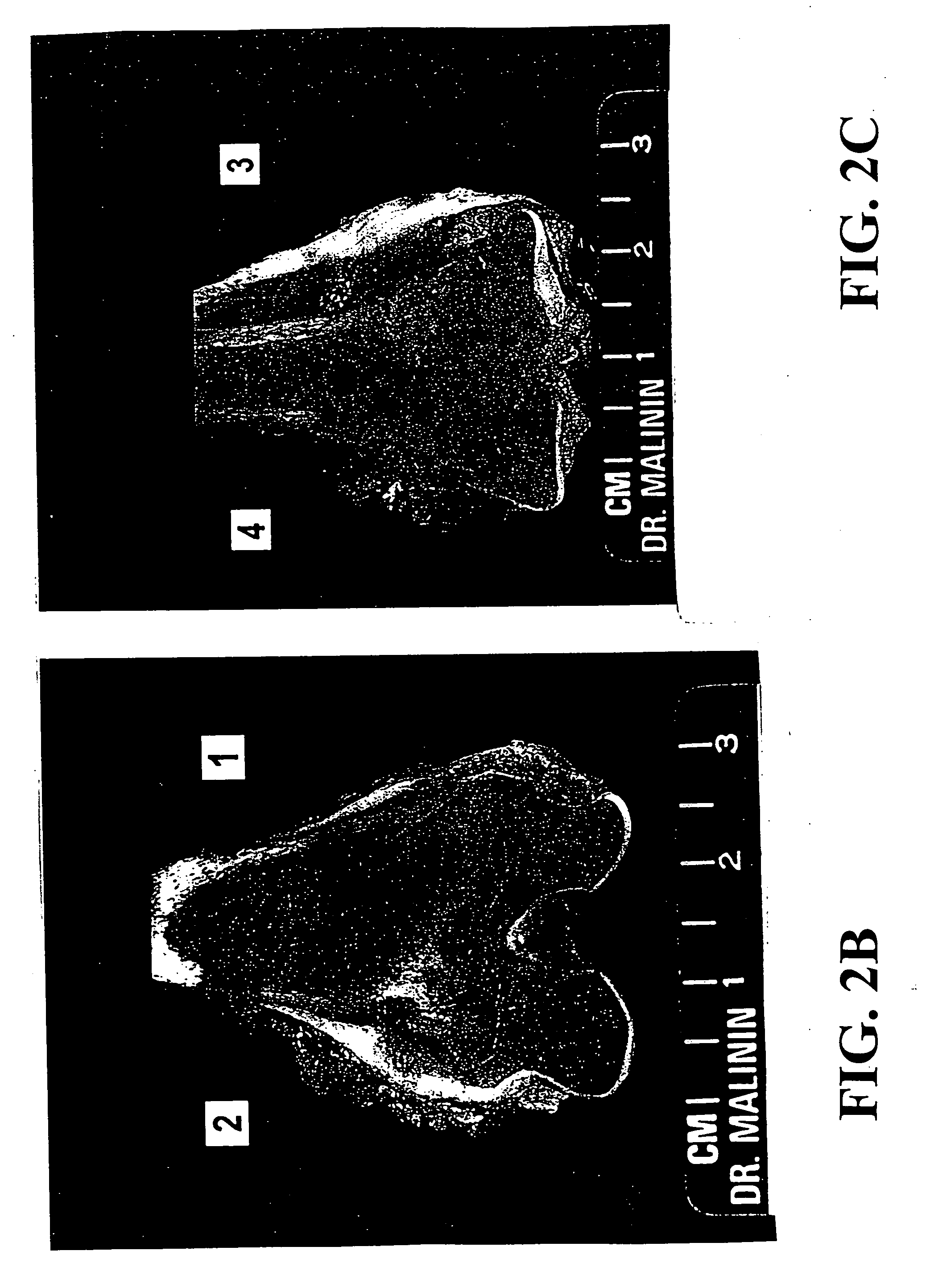 Transplantable particulate bone composition having high osteoinductive capacity and methods for making and using same