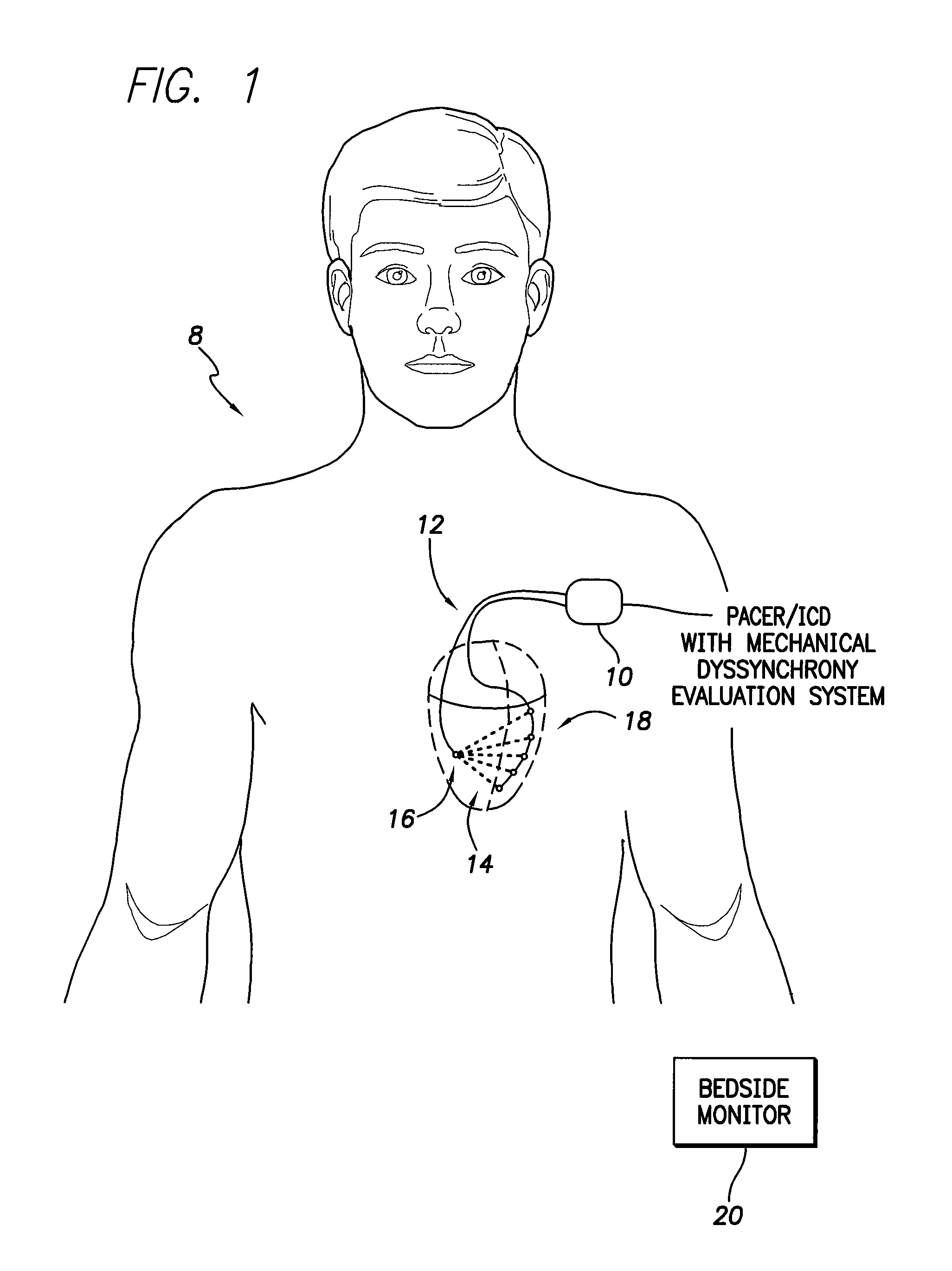 System and method for evaluating mechanical cardiac dyssynchrony based on multiple impedance vectors using an implantable medical device