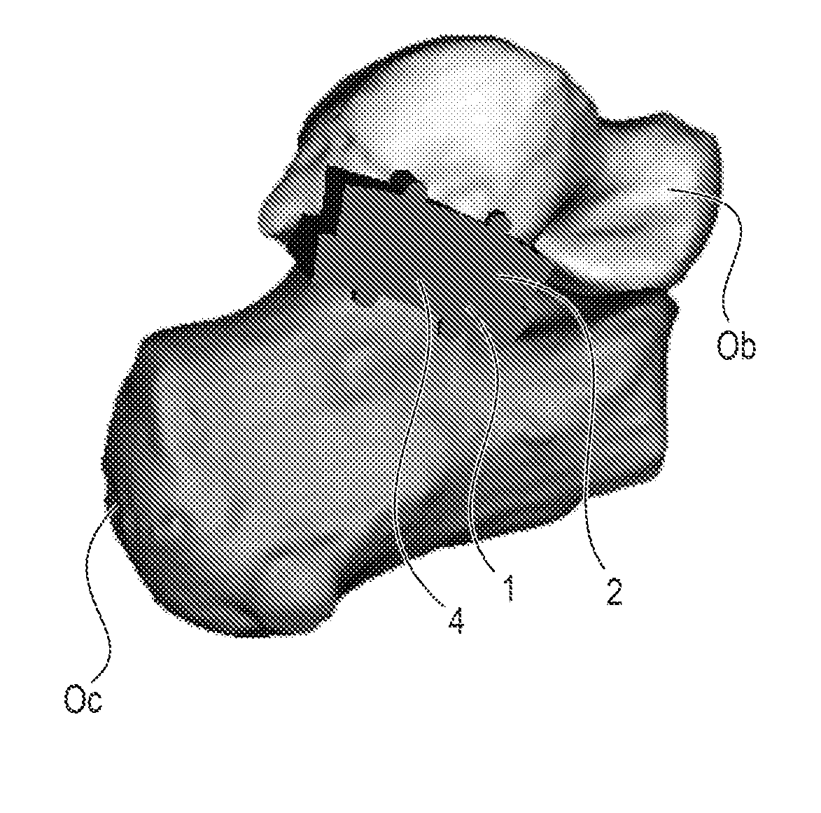 Subtalar Joint Prostheseis and Its Method of Implantation