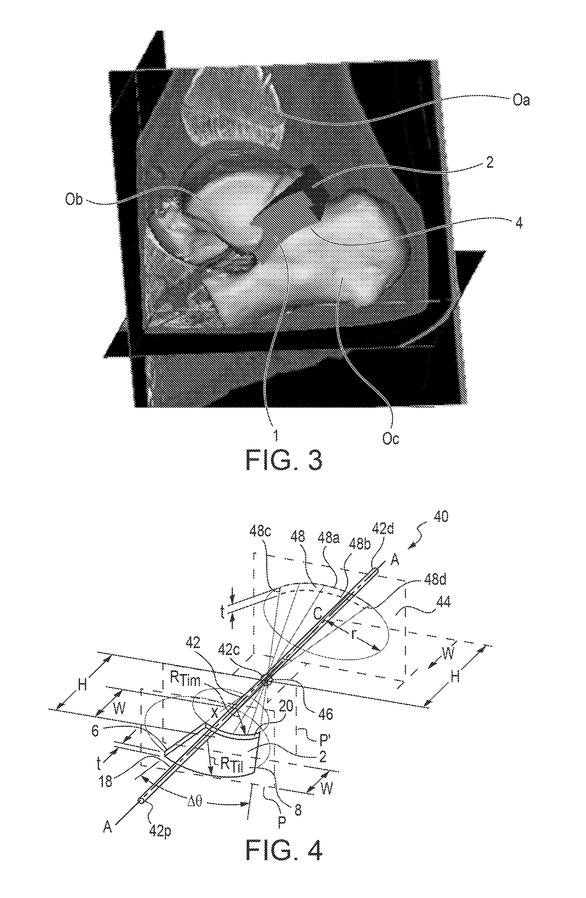 Subtalar Joint Prostheseis and Its Method of Implantation