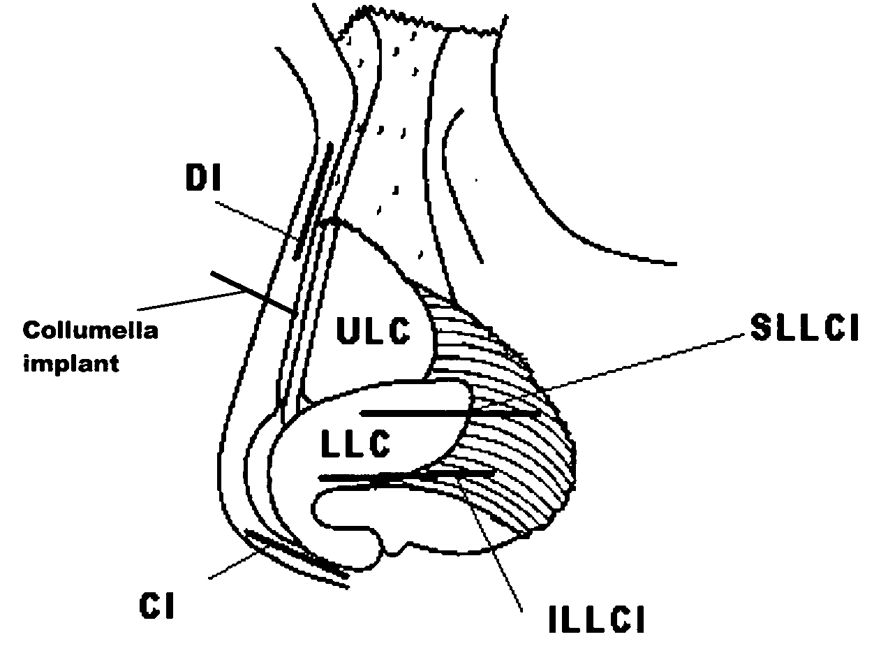 Nasal implant introduced through a non-surgical injection technique