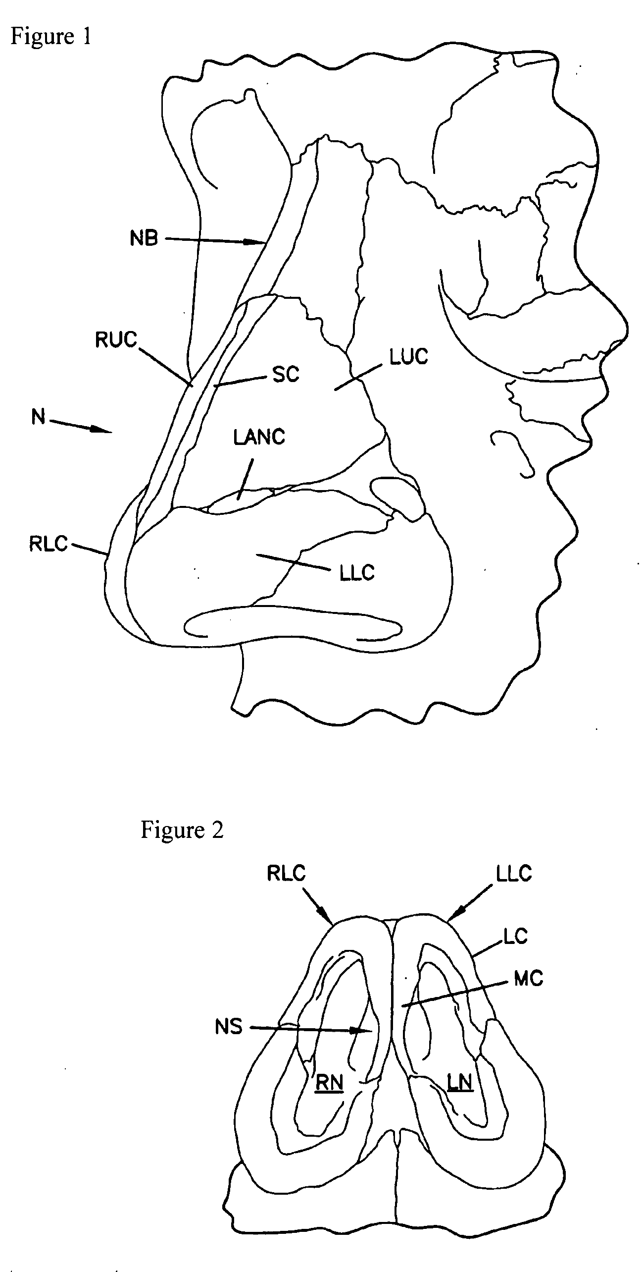 Nasal implant introduced through a non-surgical injection technique