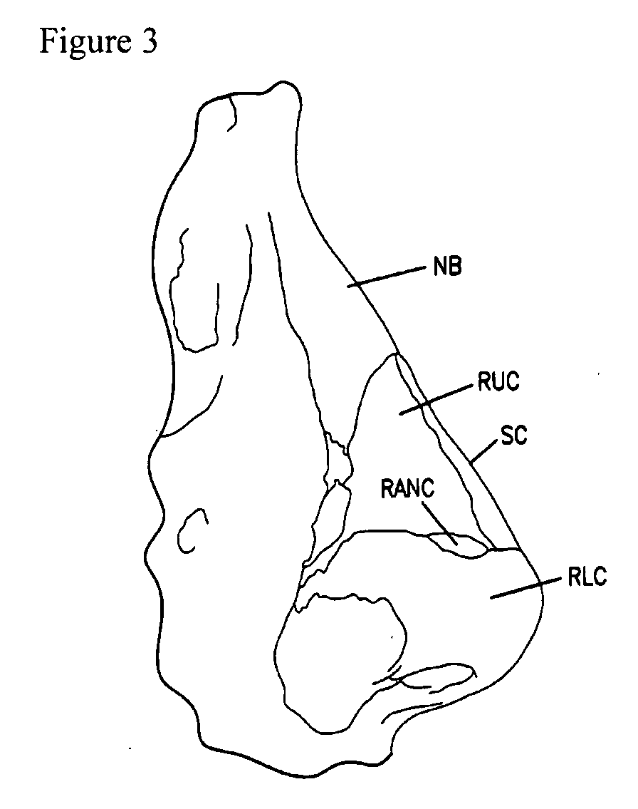 Nasal implant introduced through a non-surgical injection technique