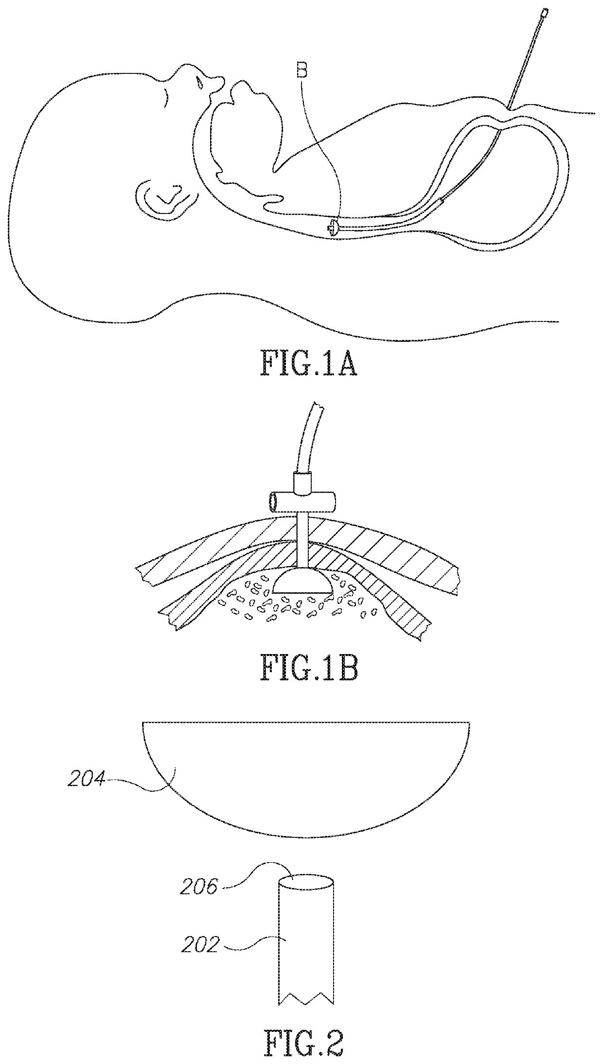 Devices and methods for percutaneous endoscopic gastrostomy and other ostomy procedures