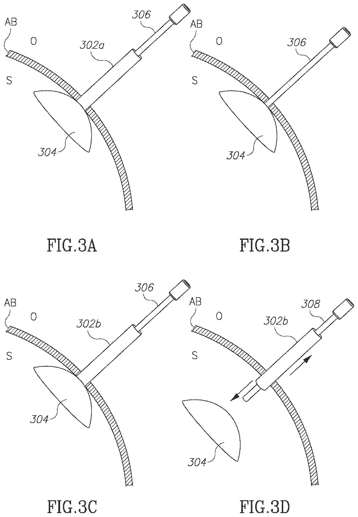 Devices and methods for percutaneous endoscopic gastrostomy and other ostomy procedures