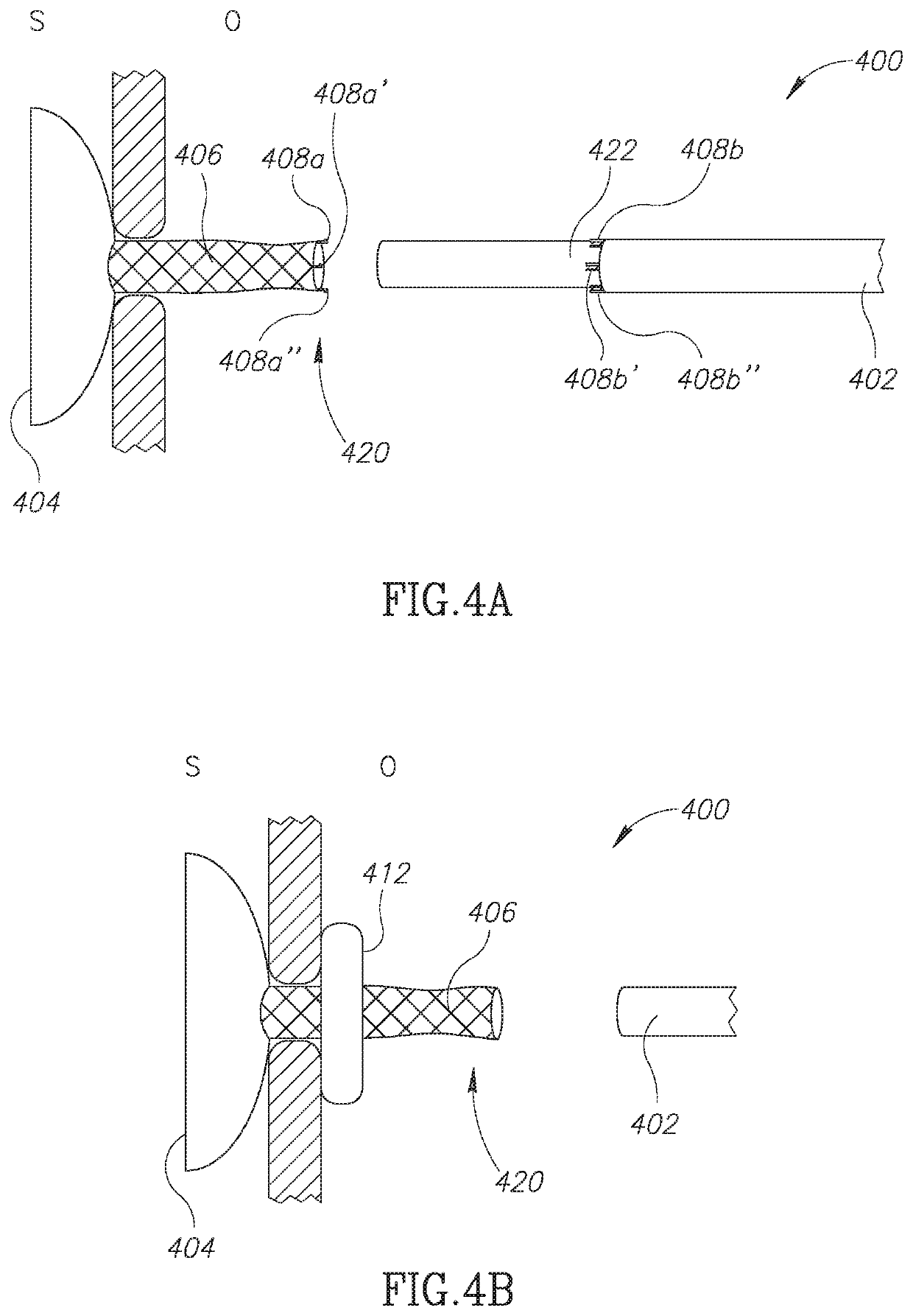 Devices and methods for percutaneous endoscopic gastrostomy and other ostomy procedures