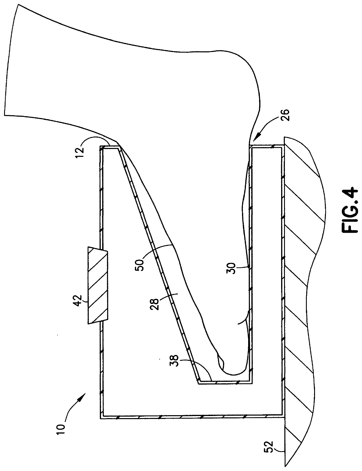 Cold Block for Decreasing Neuropathy During Chemotherapy