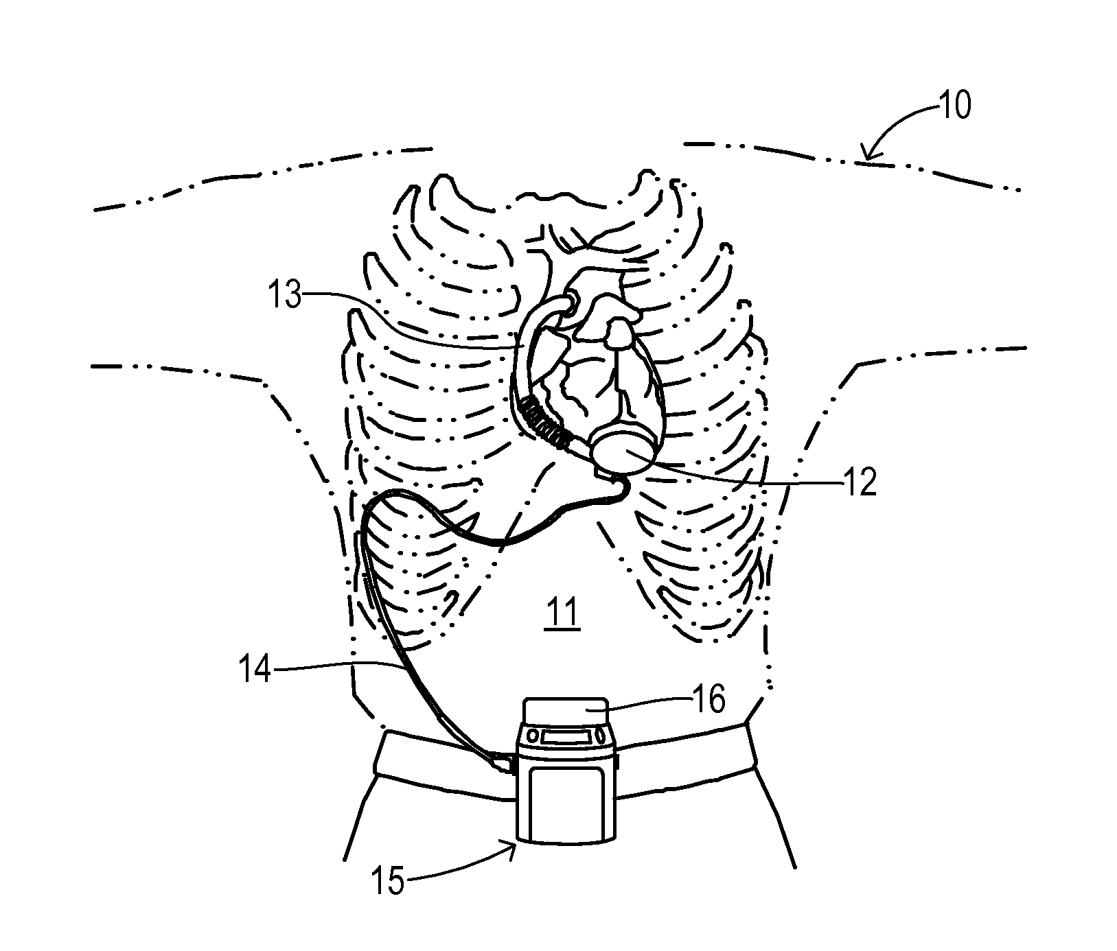 Cardiac pump with speed adapted for ventricle unloading