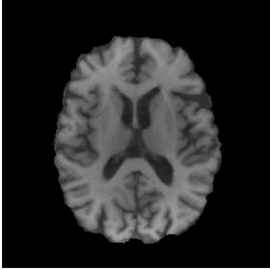 Partition method for multiple-sclerosis damage area