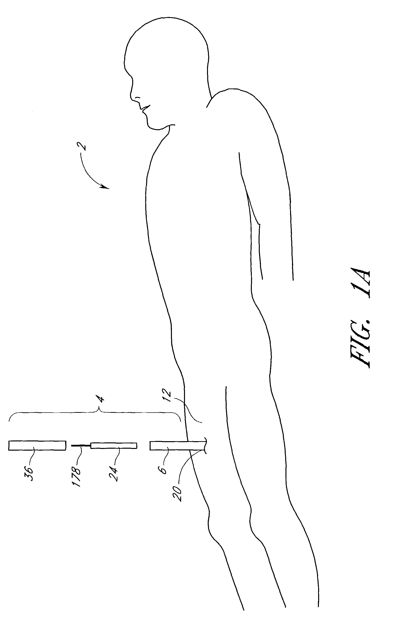 Suturing device and method for sealing an opening in a blood vessel for other biological structure