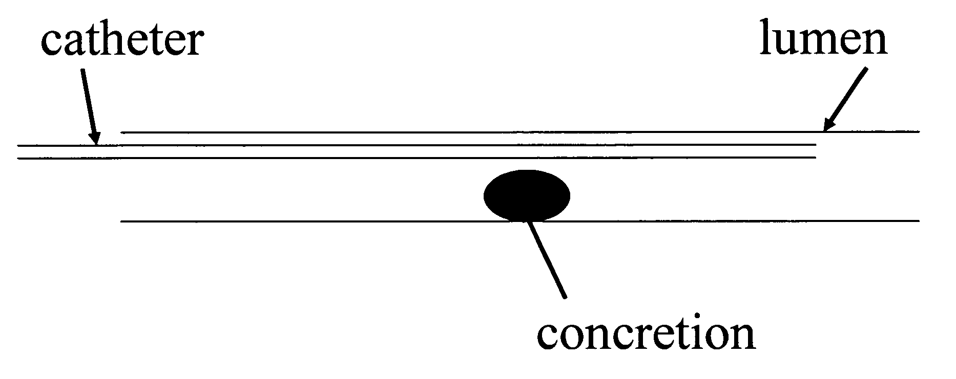 Confinement of kidney-stone fragments during lithotripsy