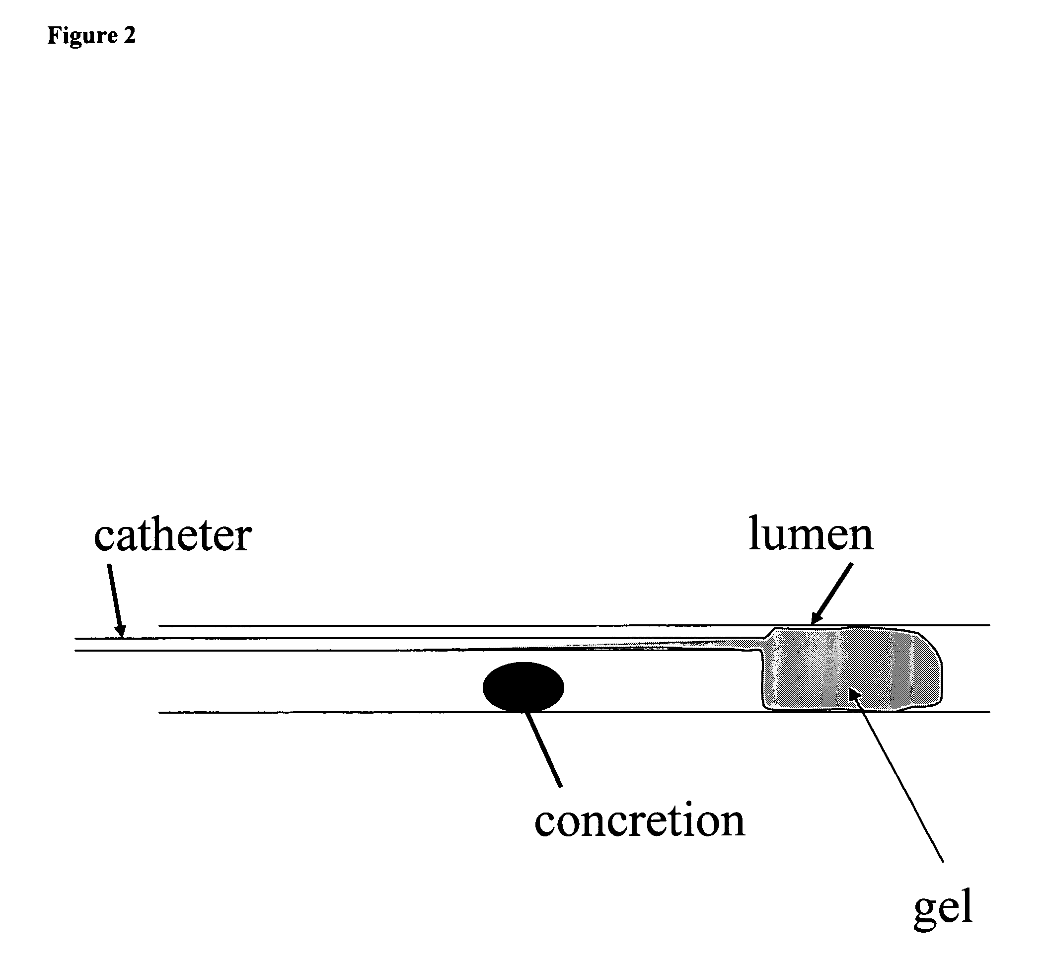 Confinement of kidney-stone fragments during lithotripsy