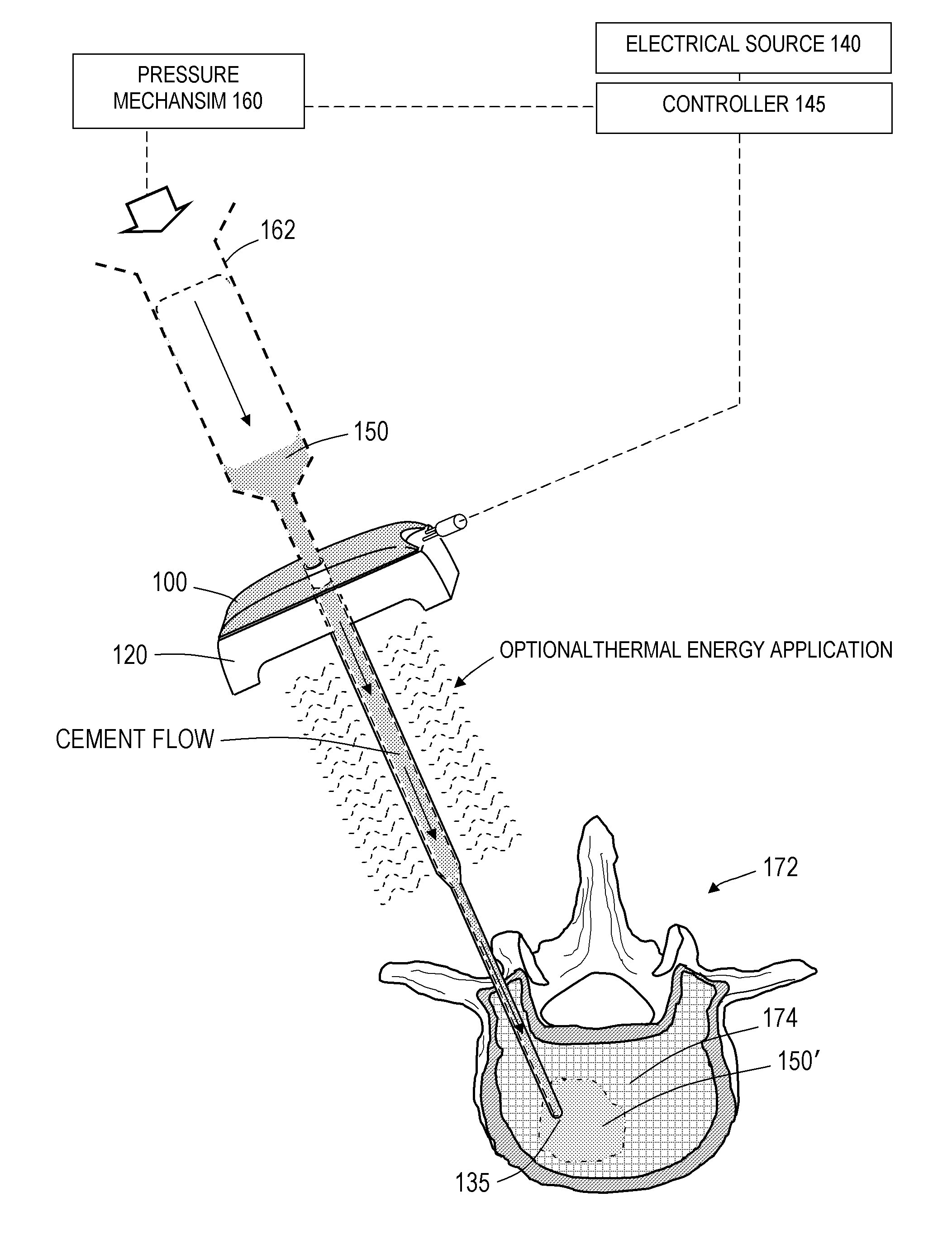 Bone treatment systems and methods