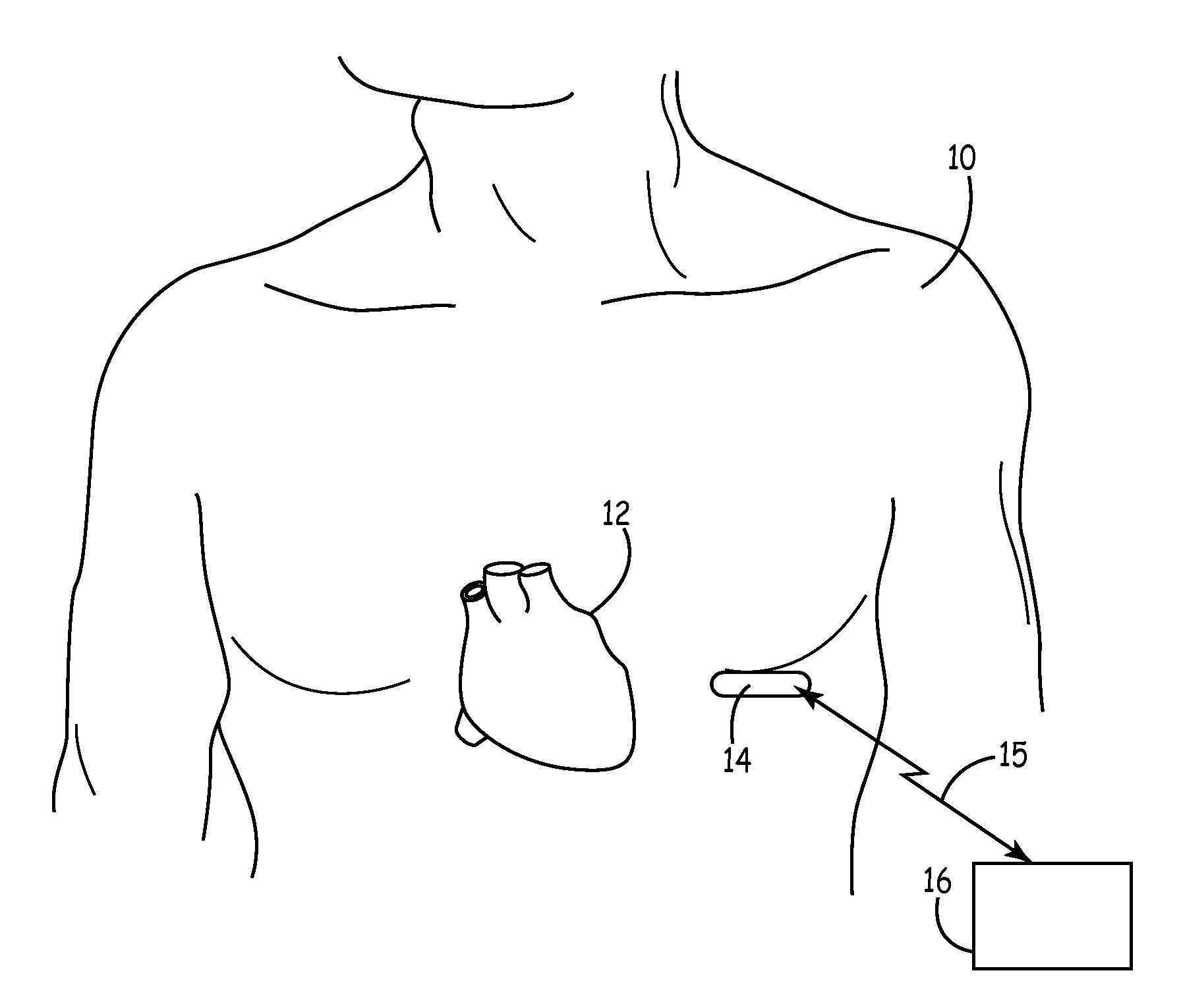 Tools and method for implanting a subcutaneous device