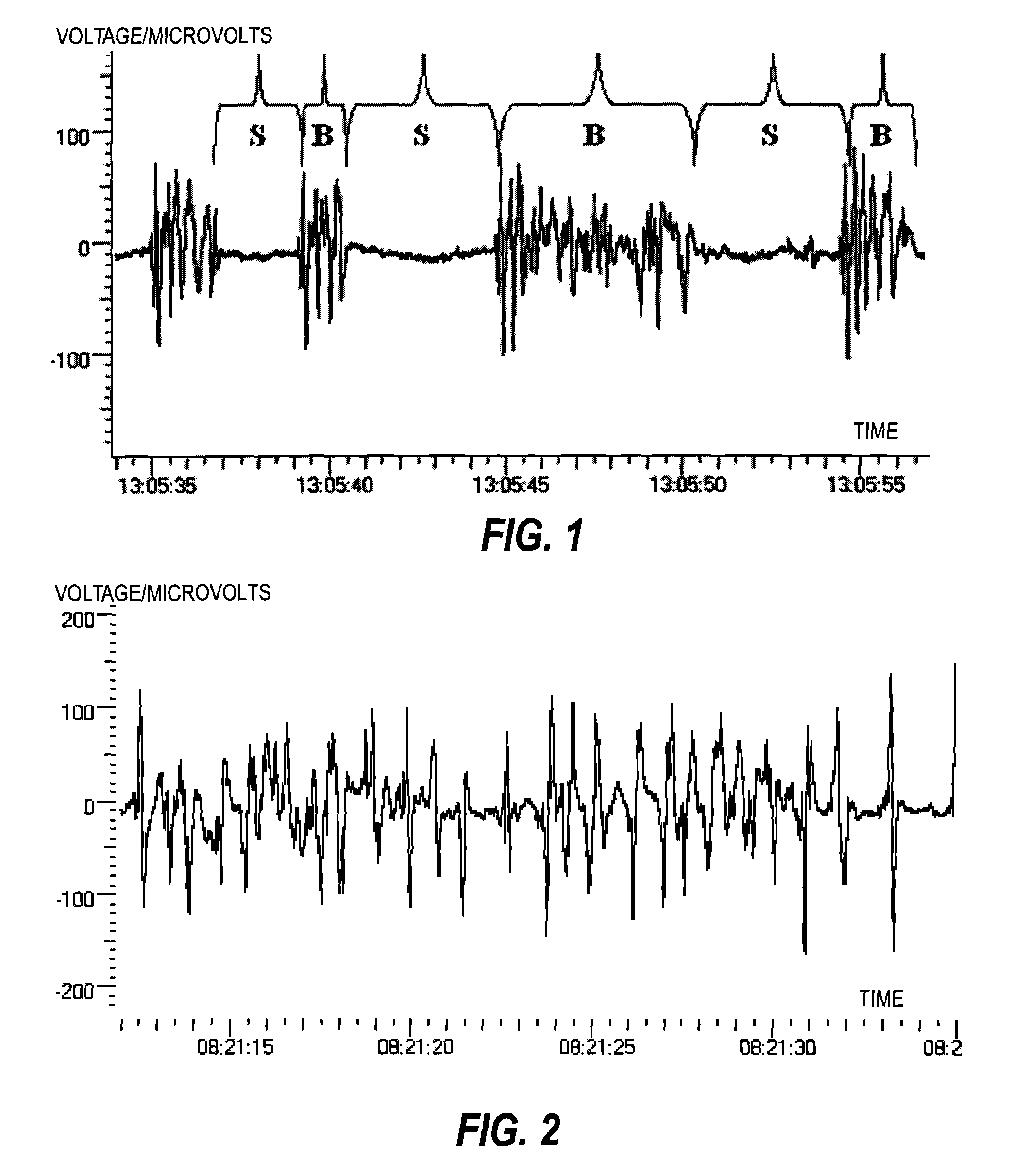 Processing of Physiological Signal Data in Patient Monitoring