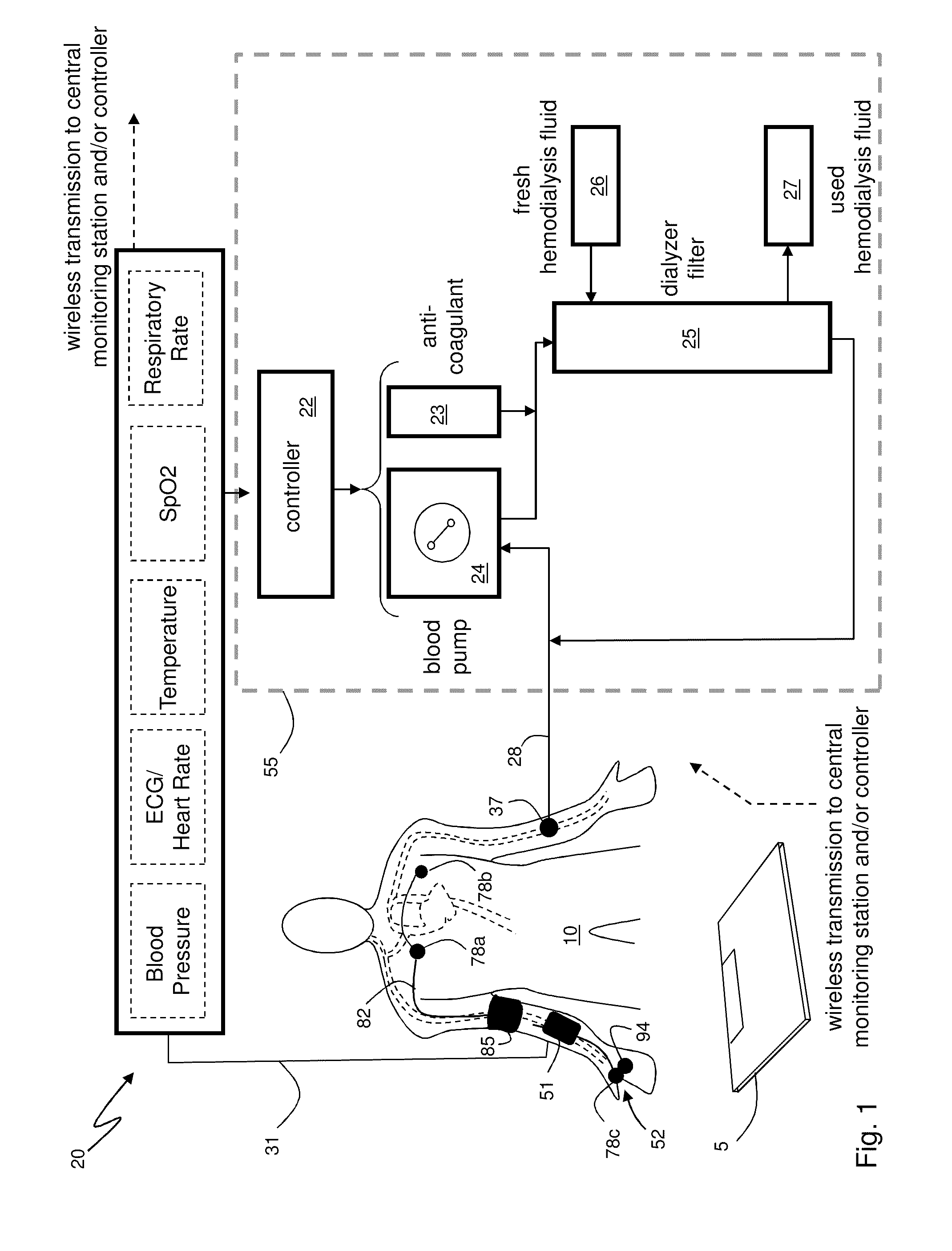 System for measuring vital signs during hemodialysis