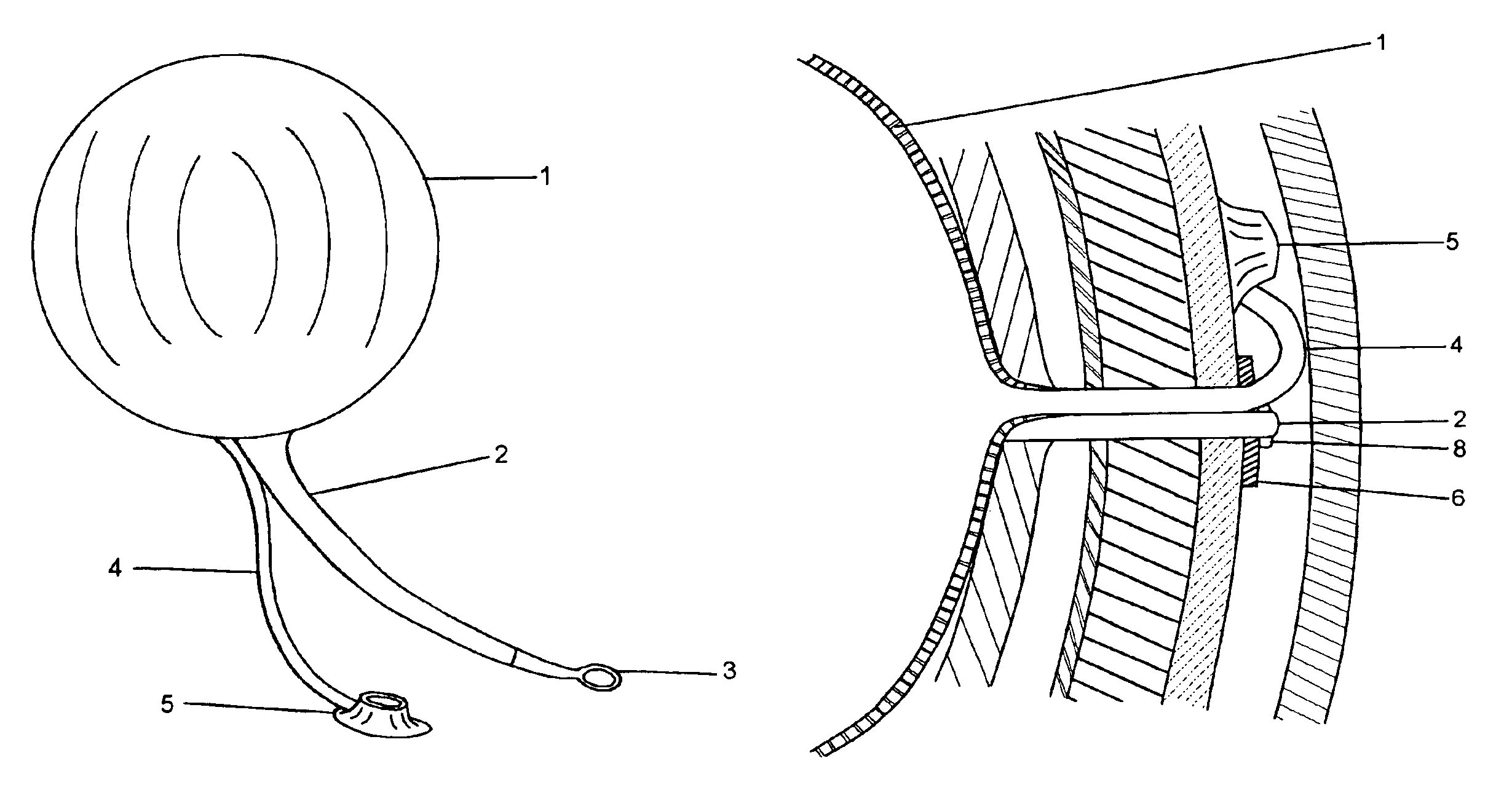 Intragastric balloon assembly