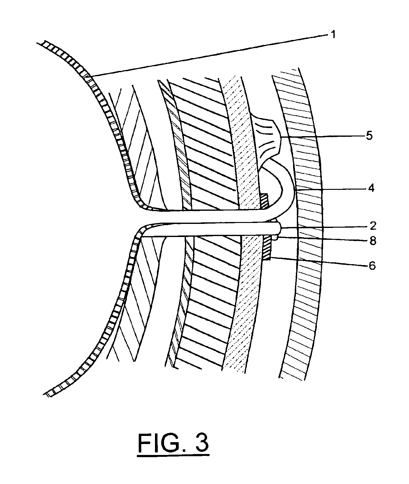 Intragastric balloon assembly