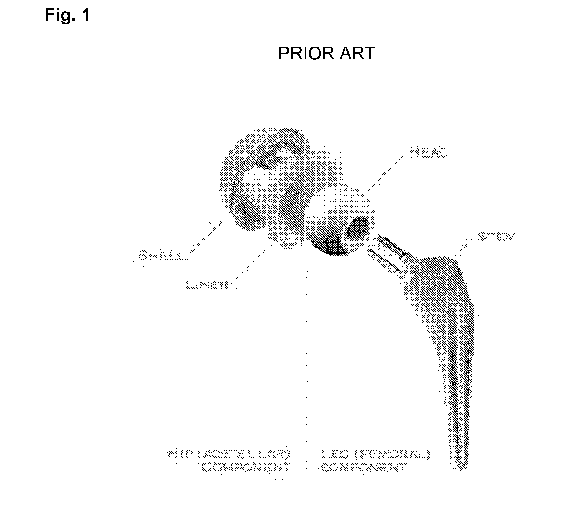 System and method for precise prosthesis positioning in hip arthroplasty