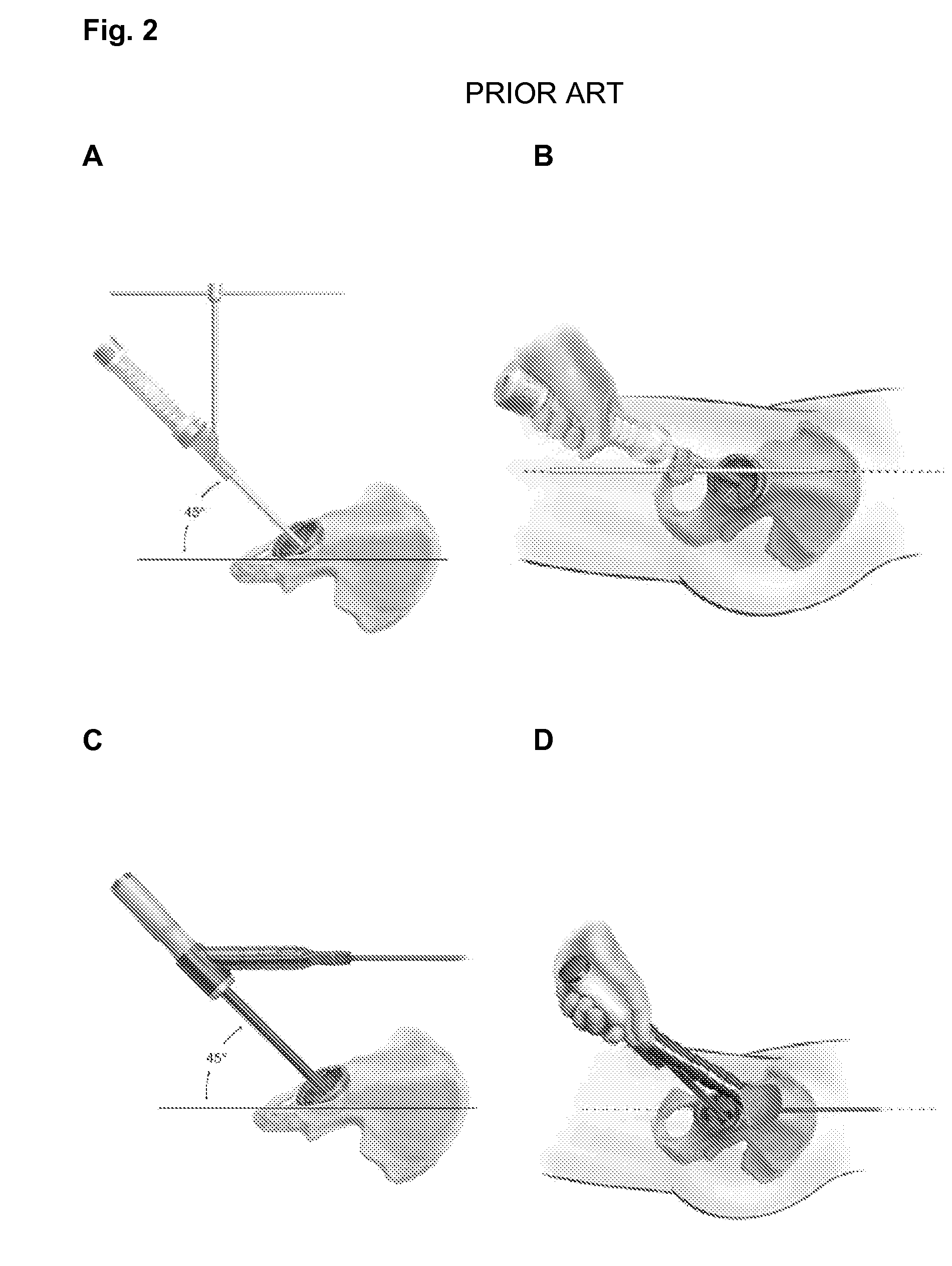 System and method for precise prosthesis positioning in hip arthroplasty