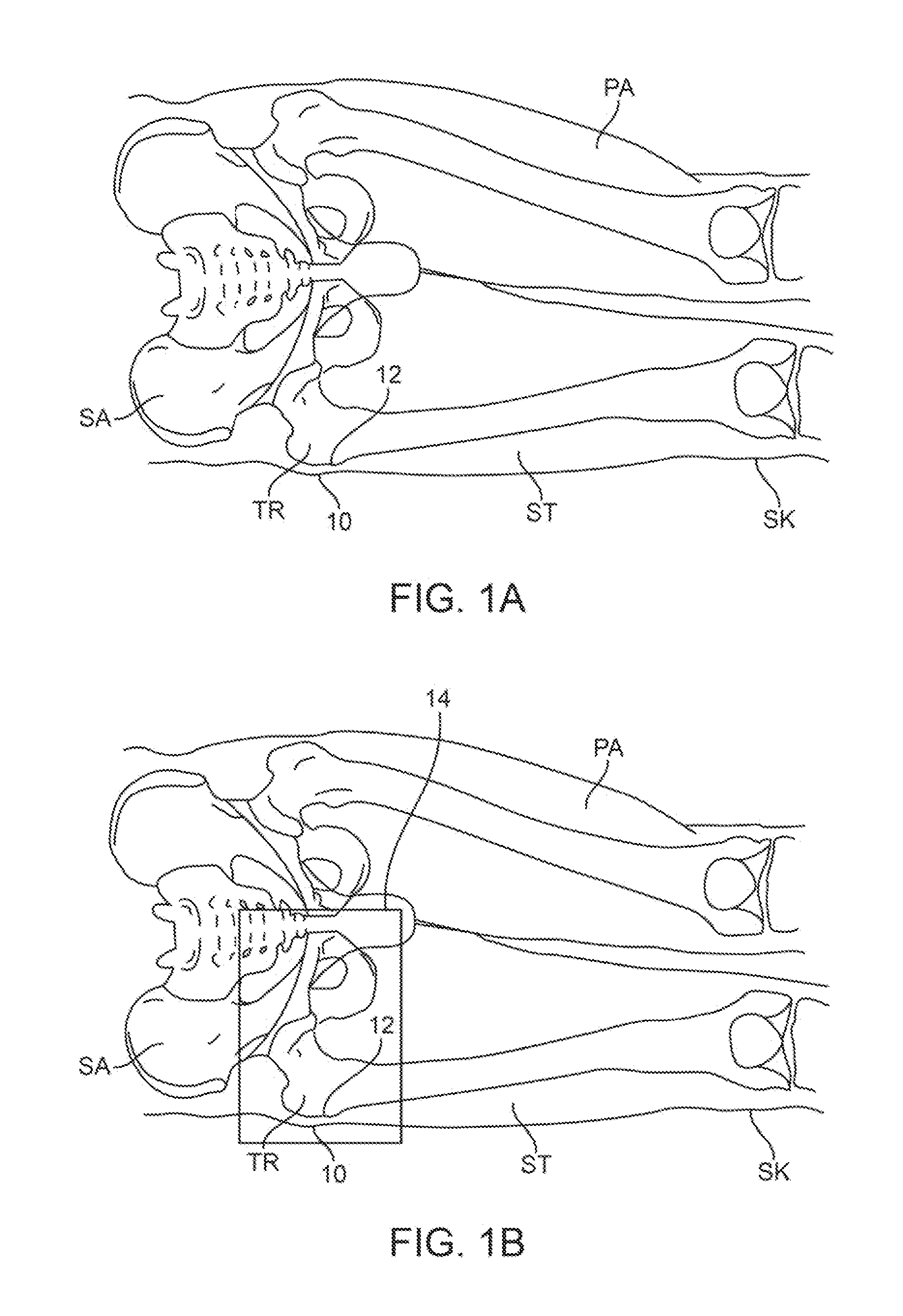 Method and devices for prevention and treatment of pressure ulcers