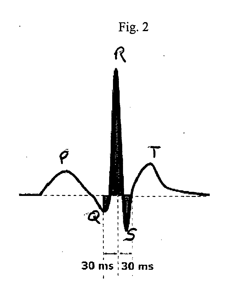 System, software, and method for detection of sleep-disordered breathing using an electrocardiogram