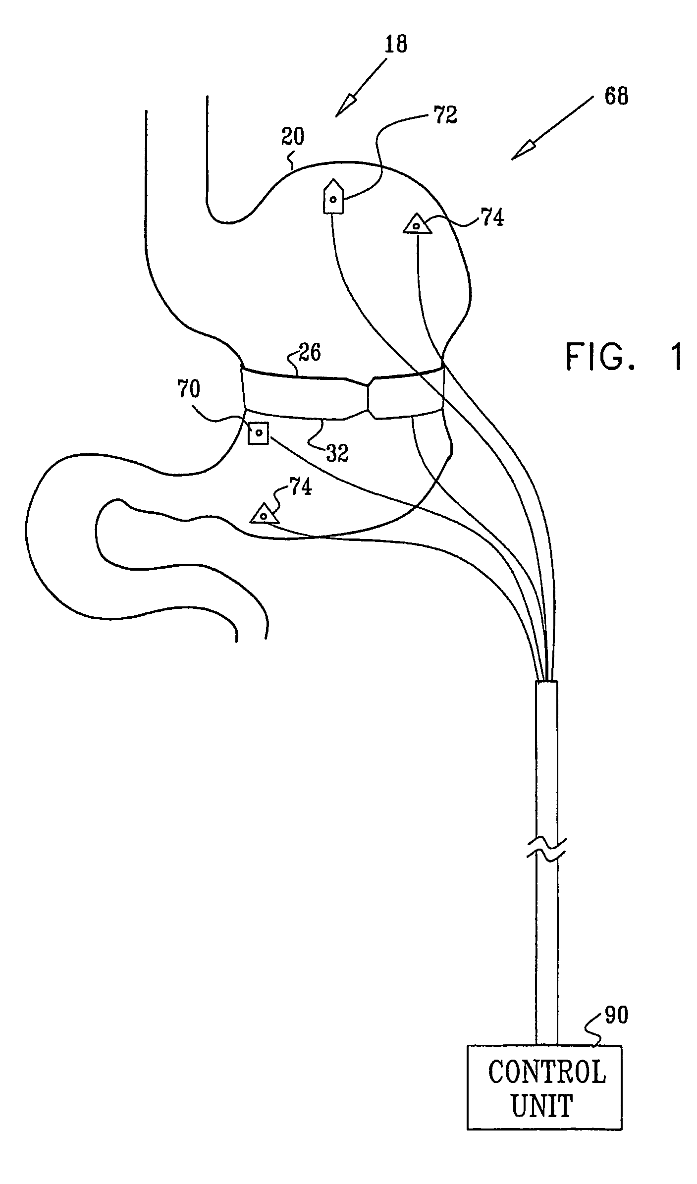 Gastrointestinal methods and apparatus for use in treating disorders and controlling blood sugar